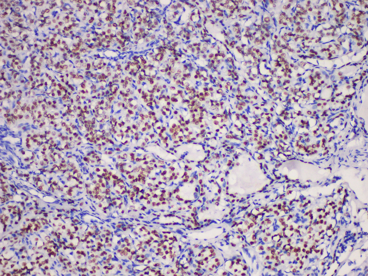 Immunohistochemistry of paraffinembedded Human thyroid  cancer tissue with Thyroid transcription factor-1(TTF1) Monoclonal Antibody(Antigen repaired by EDTA).