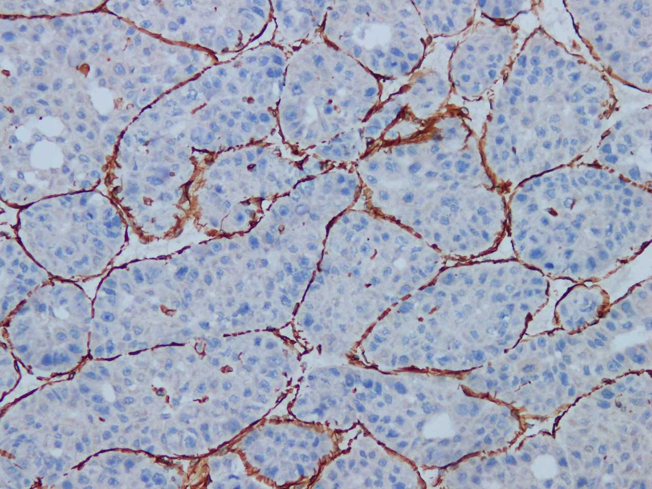 Immunohistochemistry of paraffinembedded Human liver cancer tissue with Vimentin Monoclonal Antibody(Antigen repaired by EDTA).