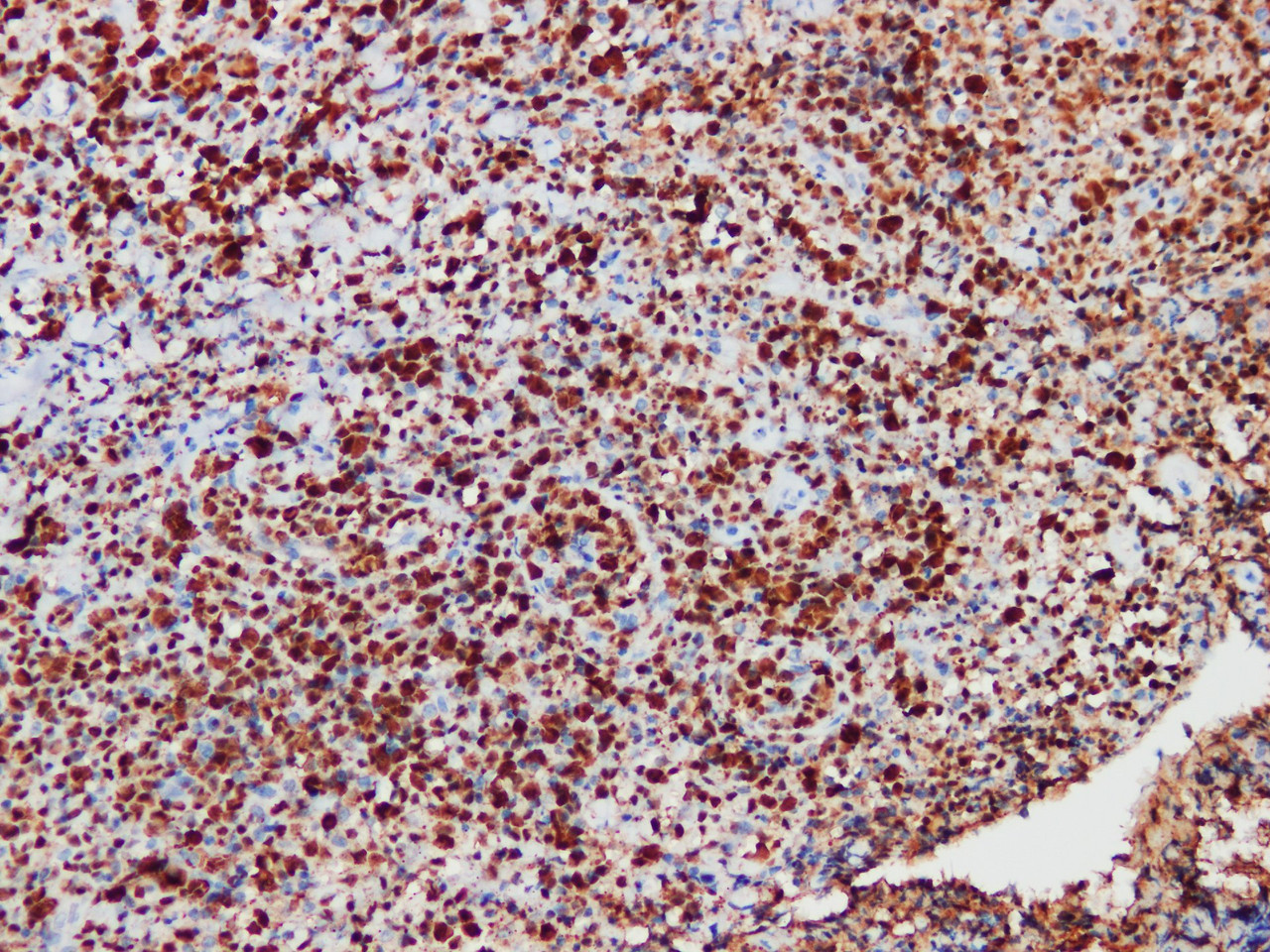 Immunohistochemistry of paraffinembedded Human anaplastic large cell lymphoma with ALK Monoclonal Antibody(Antigen repaired by EDTA).