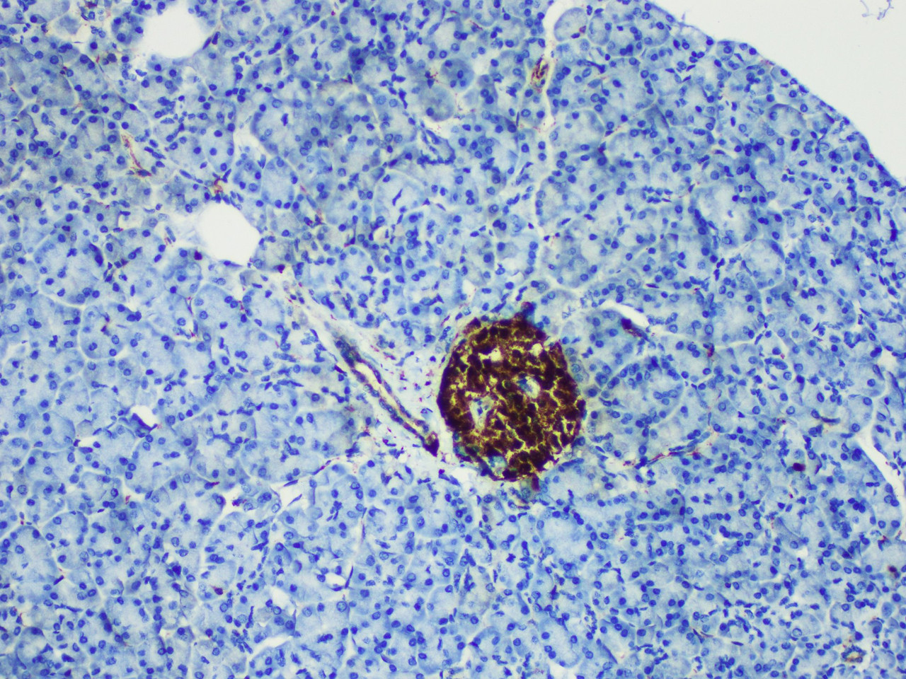 Immunohistochemistry of paraffinembedded Human pancreatic tissue with NSE Monoclonal Antibody(Antigen repaired by EDTA).