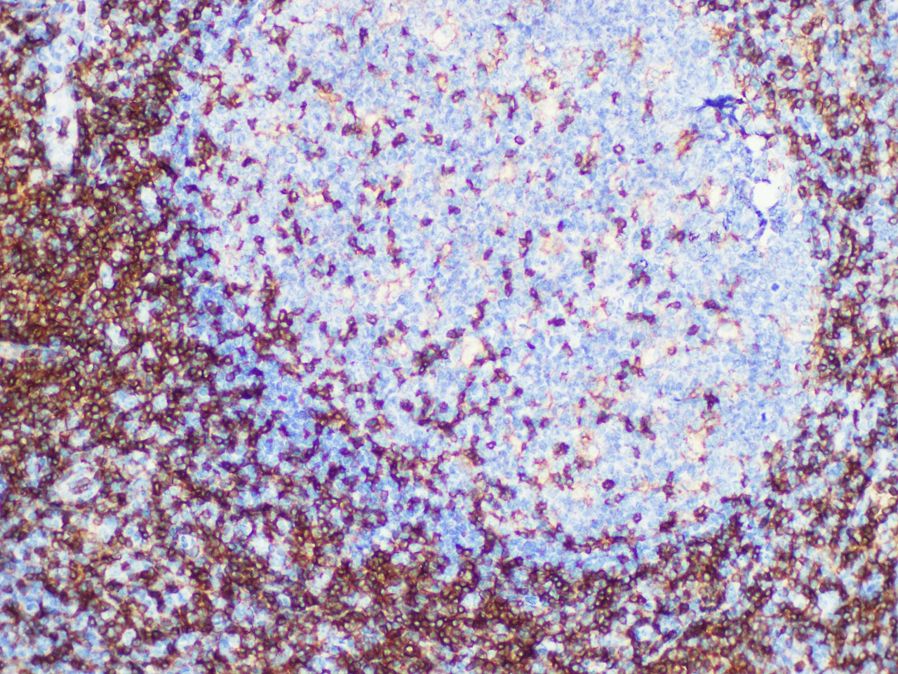 Immunohistochemistry of paraffinembedded Human tonsil tissue with CD4 Monoclonal Antibody(Antigen repaired by EDTA).