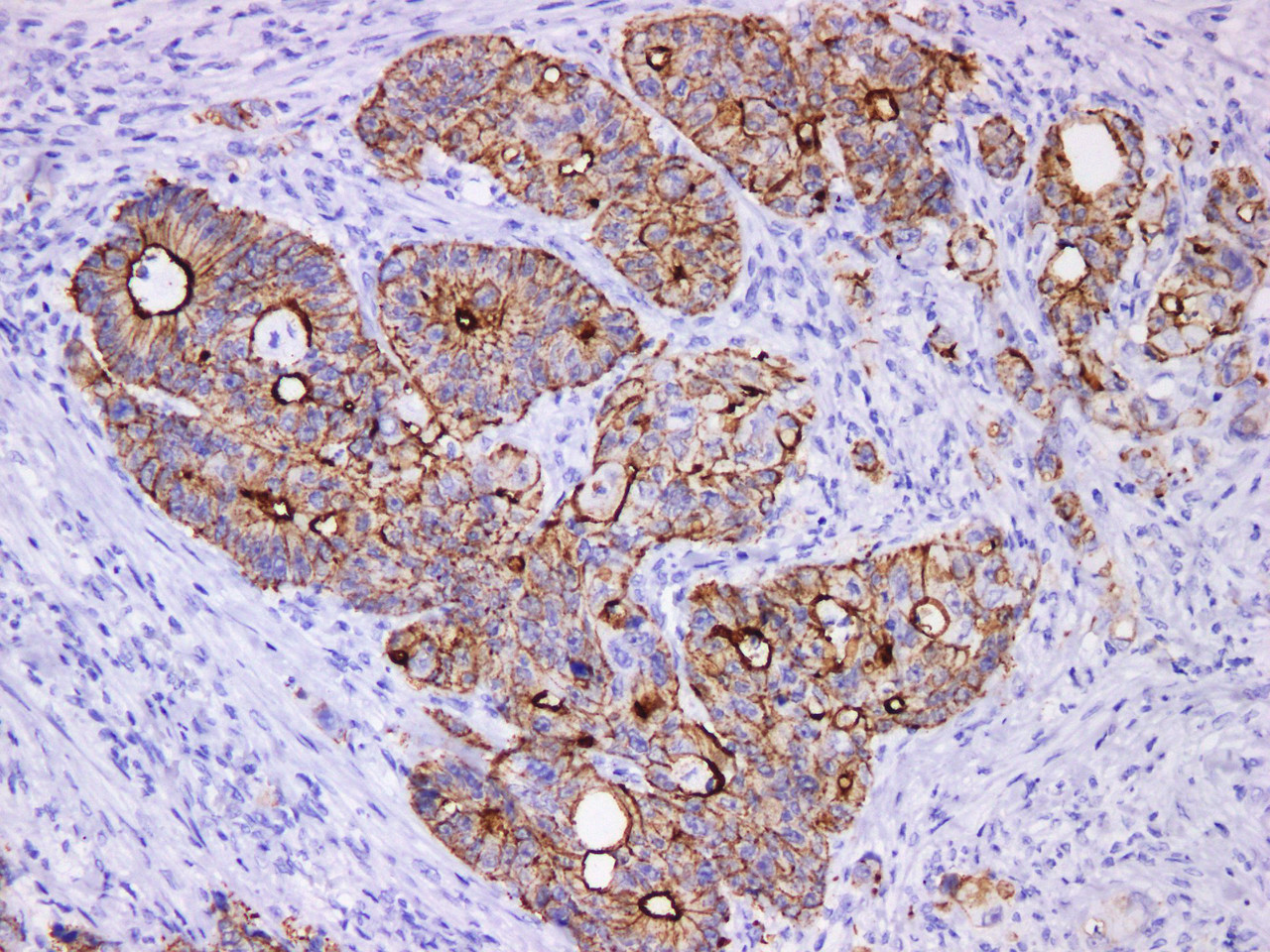 Immunohistochemistry of paraffinembedded Human colon cancer tissue with Villin Monoclonal Antibody(Antigen repaired by EDTA).