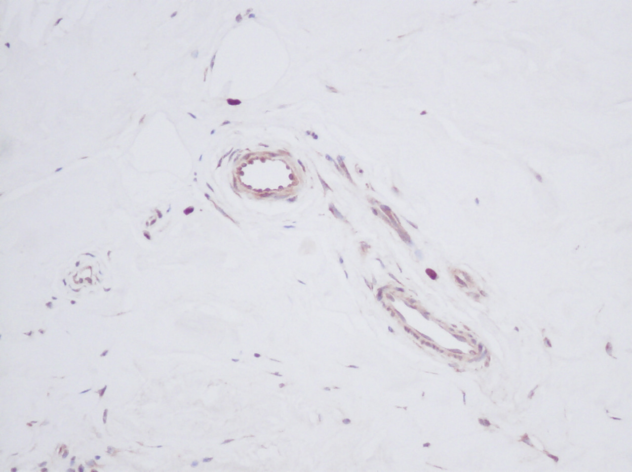 This antibody stained formalin-fixed, paraffin-embedded sections of human breast invasive ductal carcinoma. The recommended concentration is 0.5 ug/ml with a two-hour incubation at room temperature. An HRP-labeled polymer detection system was used with a DAB chromogen. Heat induced antigen retrieval with a pH 6.0 Sodium Citrate buffer is recommended. Optimal concentrations and conditions may vary.
