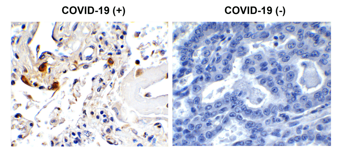 Figure 1 Immunohistochemistry Validation of SARS-CoV-2 (COVID-19) Envelope in COVID-19 Patient Lung 
Immunohistochemical analysis of paraffin-embedded COVID-19 patient lung tissue using anti- SARS-CoV-2 (COVID-19) Envelope antibody (3531, 1 &#956;g/mL) . Tissue was fixed with formaldehyde and blocked with 10% serum for 1 h at RT; antigen retrieval was by heat mediation with a citrate buffer (pH6) . Samples were incubated with primary antibody overnight at 4&#730;C. A goat anti-rabbit IgG H&L (HRP) at 1/250 was used as secondary. Counter stained with Hematoxylin. Strong signal of SARS-COV-2 envelope protein was observed in macrophage of COVID-19 patient lung, but not in non-COVID-19 patient lung.