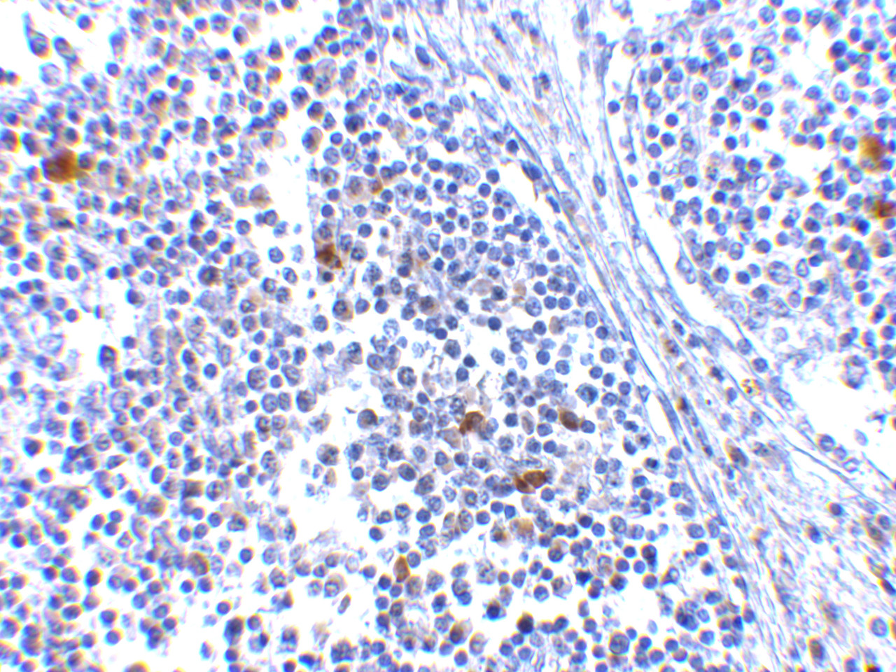 Immunohistochemistry of MDA5 in human lymph node tissue with MDA5 antibody at 5 ug/mL.