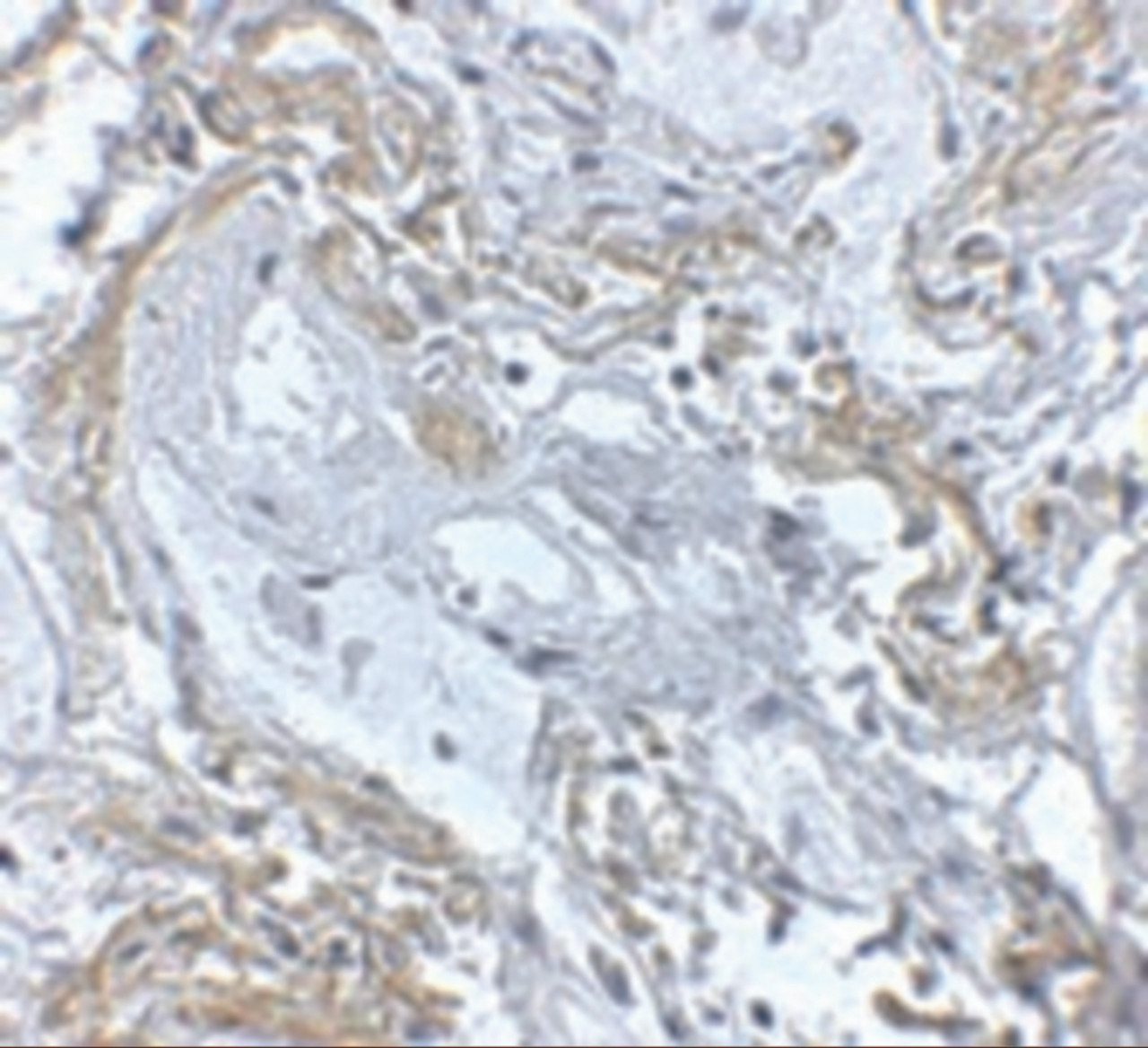 Immunohistochemistry of TNFAIP3 in human lung tissue with TNFAIP3 antibody at 5 ug/mL.