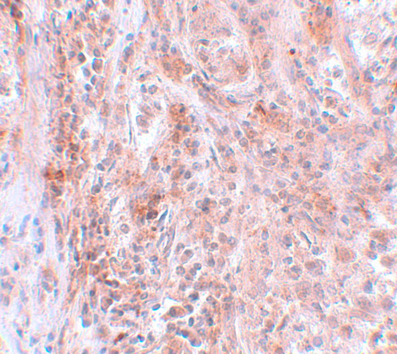 Immunohistochemistry of BCAS2 in human breast carcinoma with BCAS2 antibody at 5 ug/mL.