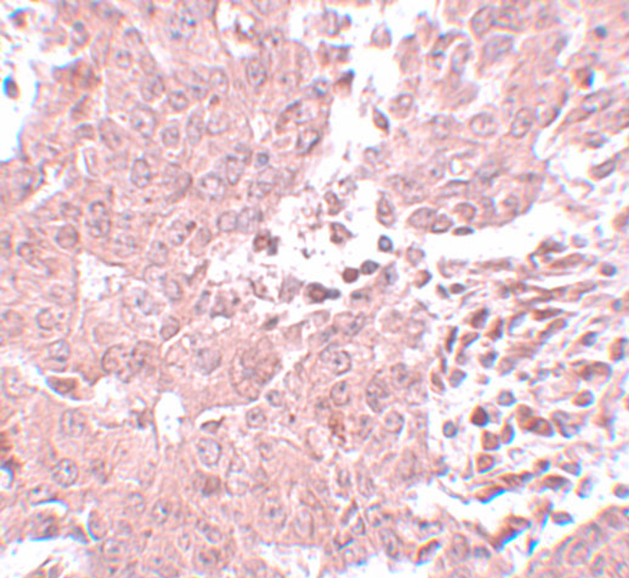 Immunohistochemistry of BCAS3 in human breast carcinoma with BCAS3 antibody at 5 ug/mL.