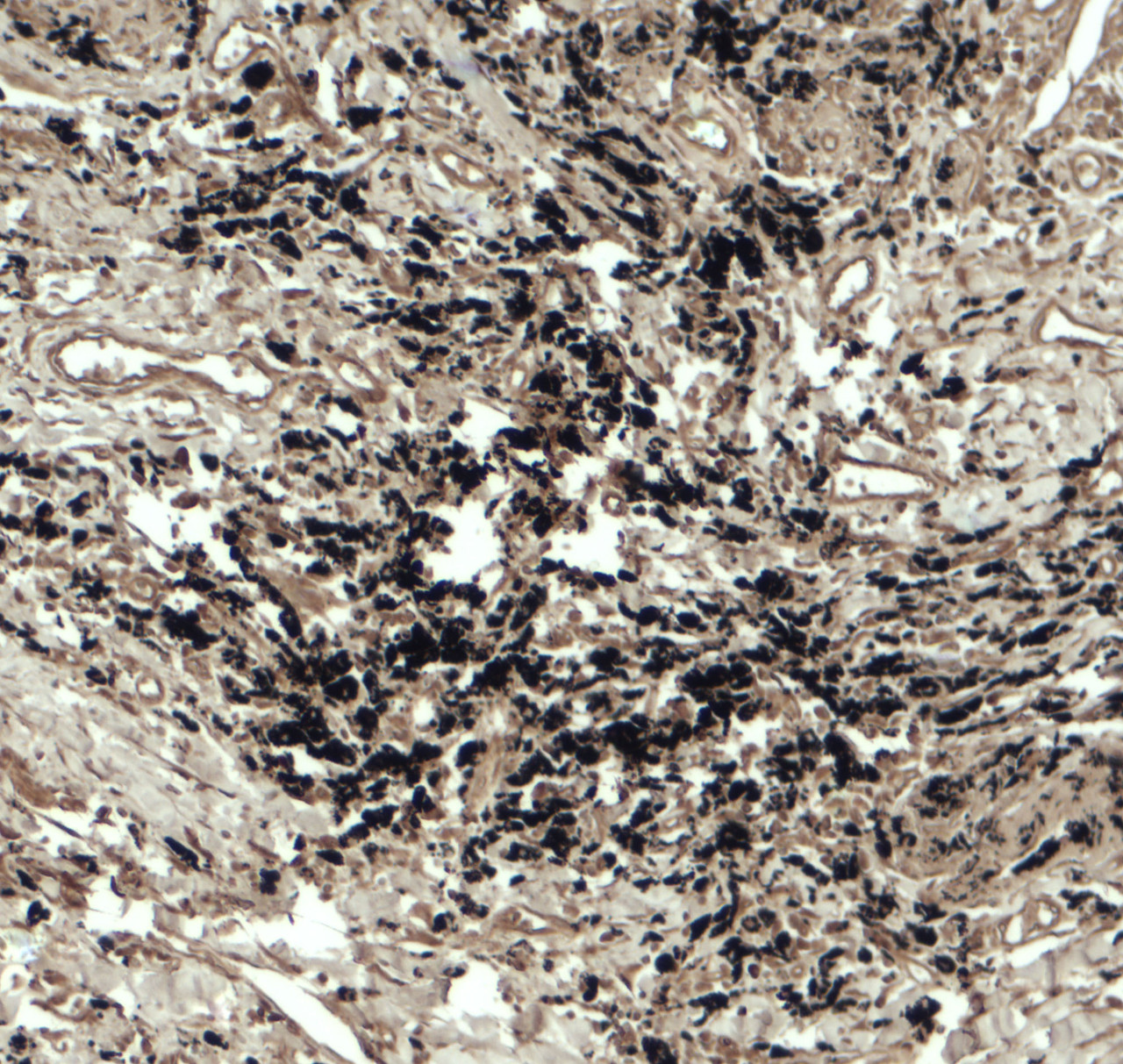 Immunohistochemistry of Beclin 2 in human lung carcinoma tissue with Beclin 2 antibody at 5 ug/ml.