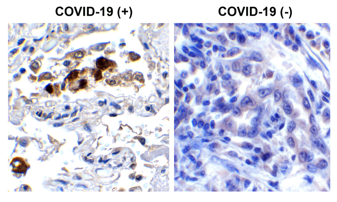 Figure 2 Immunohistochemistry Validation of SARS-CoV-2 (COVID-19) Spike RBD in COVID-19 Patient Lung 
Immunohistochemical analysis of paraffin-embedded COVID-19 patient lung tissue using anti- SARS-CoV-2 (COVID-19) Spike RBD antibody (9087, 0.5 ug/mL) . Tissue was fixed with formaldehyde and blocked with 10% serum for 1 h at RT; antigen retrieval was by heat mediation with a citrate buffer (pH6) . Samples were incubated with primary antibody overnight at 4&#730;C. A goat anti-rabbit IgG H&L (HRP) at 1/250 was used as secondary. Counter stained with Hematoxylin. Strong signal of SARS-COV-2 Spike RBD protein was observed in macrophage of COVID-19 patient lung, but not in non-COVID-19 patient lung.