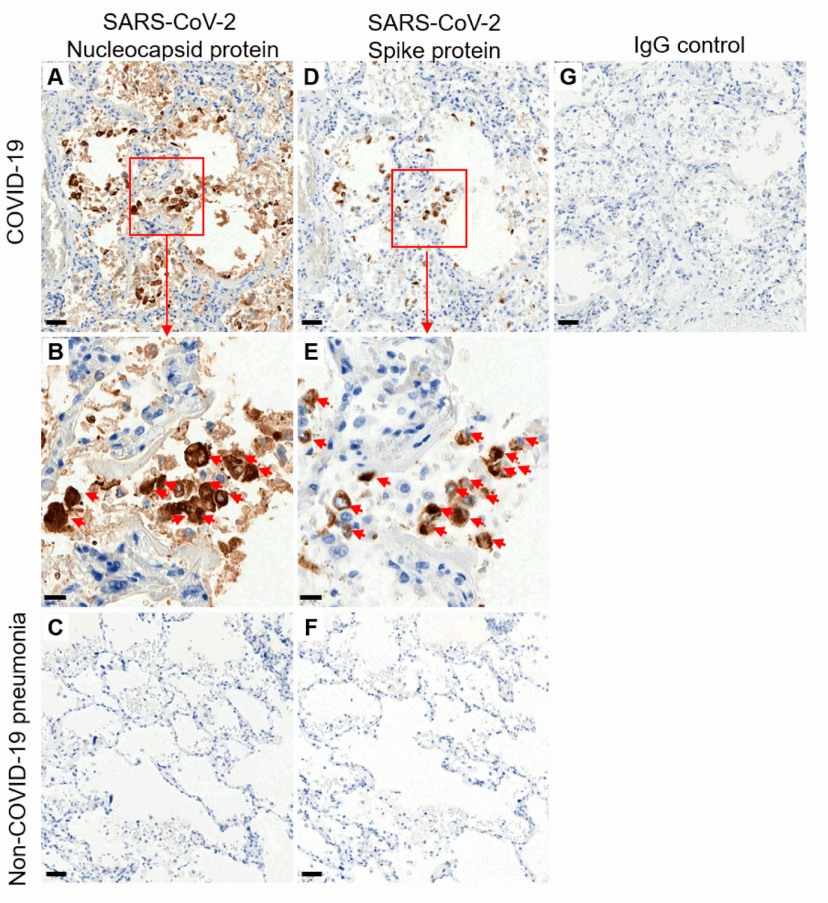 Figure 1 Immunohistochemistry Validation of SARS-CoV-2 (COVID-19) Nucleocapsid in Human Lung Tissue from the COVID-19 Patient (Sun et al., 2020)  
Detection of SARS-CoV-2 nucleocapsid protein by anti-SARS-COV-2 nucleocapsid antibodies (9099, 0.02 &#956;g/mL, A, B) or SARS-CoV-2 Spike S1 antibodies (9083, 1 &#956;g/mL D, E) in adjacent sections of autopsy lung tissue from COVID-19 deceased patient. Negative control staining on autopsy lung tissue from patient who died from non-COVID-19 pneumonia is shown for Nucleocapsid protein (C) or Spike protein (F) . Negative control using normal rabbit immunoglobulin on COVID-19 autopsy tissue is presented (G) . DAB chromogen and hematoxylin counterstain are used. Scale bars: 50μM in A, C, D, F, G; 20&#956;M in B and E.