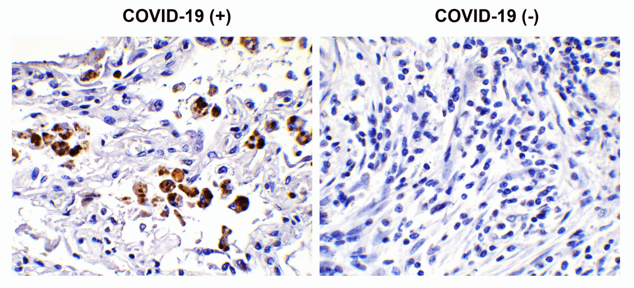 Figure 1 Immunohistochemistry Validation of SARS-CoV-2 (COVID-19) Spike S2 in COVID-19 Patient Lung 
Immunohistochemical analysis of paraffin-embedded COVID-19 patient lung tissue using anti- SARS-CoV-2 (COVID-19) Spike S2 antibody (9123, 0.1 &#956;g/mL) . Tissue was fixed with formaldehyde and blocked with 10% serum for 1 h at RT; antigen retrieval was by heat mediation with a citrate buffer (pH6) . Samples were incubated with primary antibody overnight at 4&#730;C. A goat anti-rabbit IgG H&L (HRP) at 1/250 was used as secondary. Counter stained with Hematoxylin. Strong signal of SARS-COV-2 spike protein was observed in macrophage of COVID-19 patient lung, but not in non-COVID-19 patient lung.