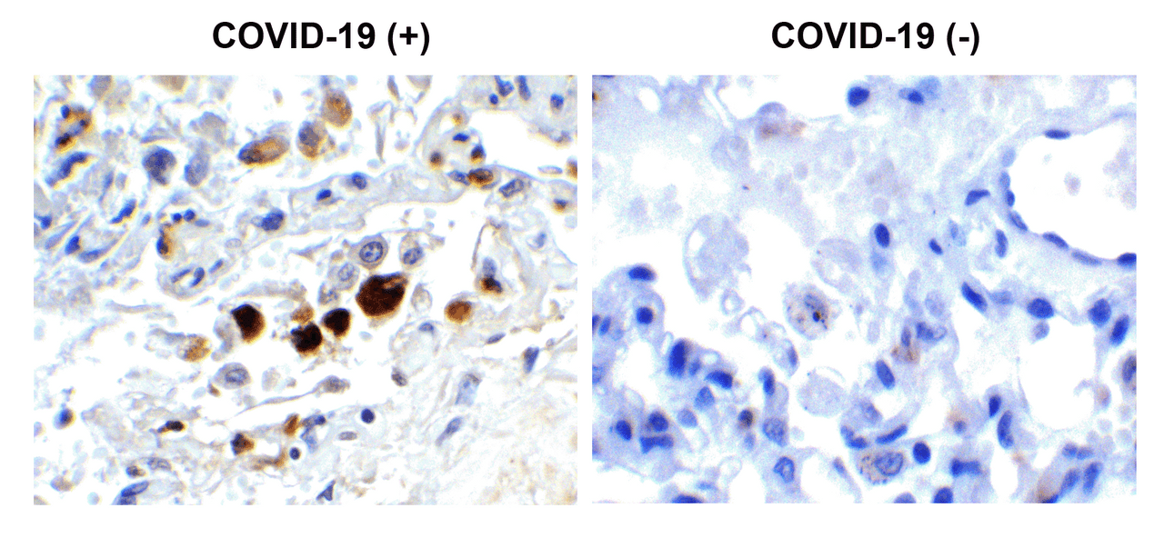 Figure 1 Immunohistochemistry Validation of SARS-CoV-2 (COVID-19) Membrane in COVID-19 Patient Lung 
Immunohistochemical analysis of paraffin-embedded COVID-19 patient lung tissue using anti- SARS-CoV-2 (COVID-19) Membrane antibody (9157, 0.5 &#956;g/mL) . Tissue was fixed with formaldehyde and blocked with 10% serum for 1 h at RT; antigen retrieval was by heat mediation with a citrate buffer (pH6) . Samples were incubated with primary antibody overnight at 4&#730;C. A goat anti-rabbit IgG H&L (HRP) at 1/250 was used as secondary. Counter stained with Hematoxylin. Strong signal of SARS-COV-2 Membrane protein was observed in macrophage of COVID-19 patient lung, but not in non-COVID-19 patient lung.