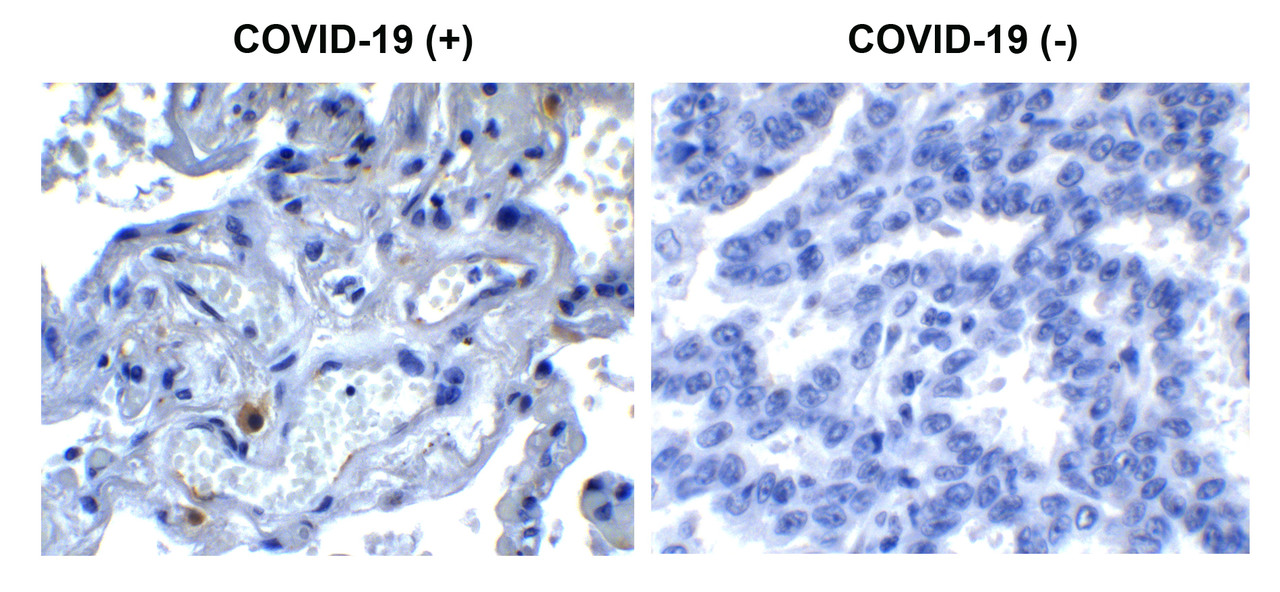 Figure 1 Immunohistochemistry Validation of SARS-CoV-2 (COVID-19) NSP9 in COVID-19 Patient Lung 
Immunohistochemical analysis of paraffin-embedded COVID-19 patient lung tissue using anti- SARS-CoV-2 (COVID-19) NSP9 antibody (9161, 0.5 &#956;g/mL) . Tissue was fixed with formaldehyde and blocked with 10% serum for 1 h at RT; antigen retrieval was by heat mediation with a citrate buffer (pH6) . Samples were incubated with primary antibody overnight at 4&#730;C. A goat anti-rabbit IgG H&L (HRP) at 1/250 was used as secondary. Counter stained with Hematoxylin. Strong signal of SARS-COV-2 NSP9 protein was observed in macrophage of COVID-19 patient lung, but not in non-COVID-19 patient lung.