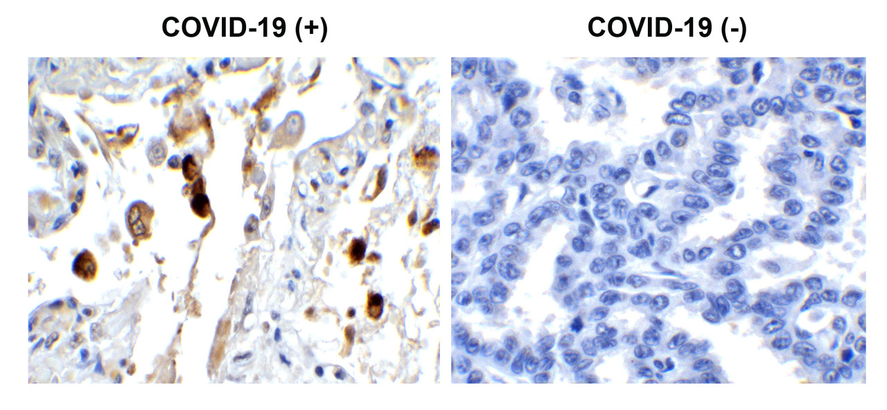 Figure 1 Immunohistochemistry Validation of SARS-CoV-2 (COVID-19) Membrane in COVID-19 Patient Lung 
Immunohistochemical analysis of paraffin-embedded COVID-19 patient lung tissue using anti- SARS-CoV-2 (COVID-19) Membrane antibody (9165, 0.5 &#956;g/mL) . Tissue was fixed with formaldehyde and blocked with 10% serum for 1 h at RT; antigen retrieval was by heat mediation with a citrate buffer (pH6) . Samples were incubated with primary antibody overnight at 4&#730;C. A goat anti-rabbit IgG H&L (HRP) at 1/250 was used as secondary. Counter stained with Hematoxylin. Strong signal of SARS-COV-2 Membrane protein was observed in macrophage of COVID-19 patient lung, but not in non-COVID-19 patient lung.