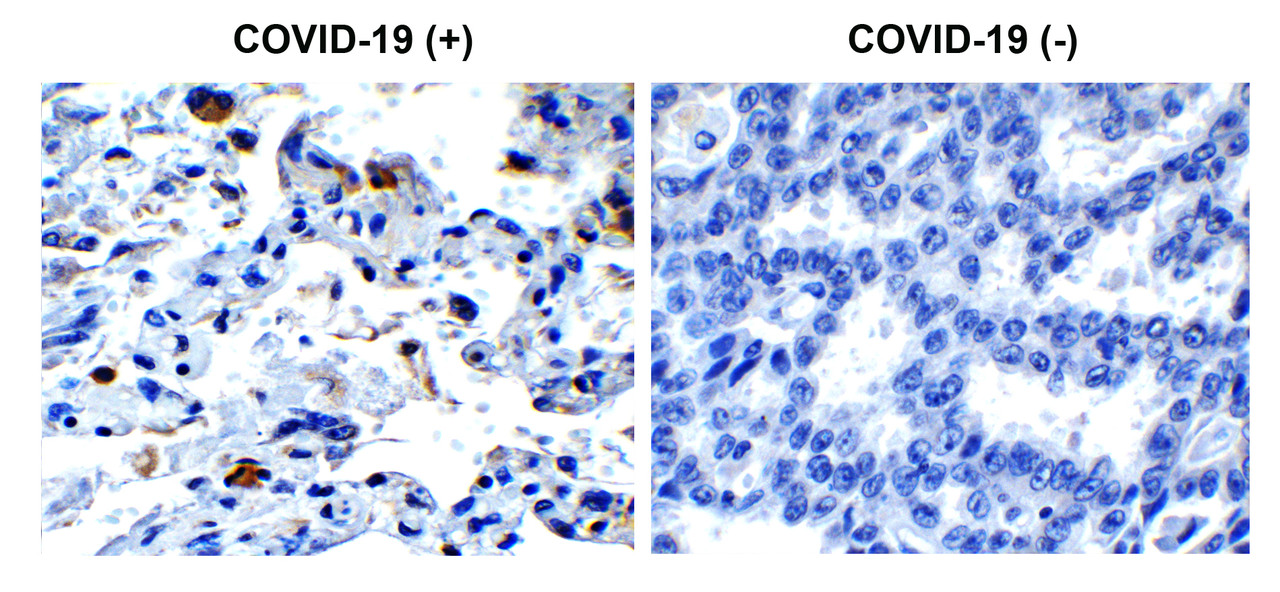 Figure 1 Immunohistochemistry Validation of SARS-CoV-2 (COVID-19) Envelope in COVID-19 Patient Lung 
Immunohistochemical analysis of paraffin-embedded COVID-19 patient lung tissue using anti- SARS-CoV-2 (COVID-19) Envelope antibody (9169, 0.5 &#956;g/mL) . Tissue was fixed with formaldehyde and blocked with 10% serum for 1 h at RT; antigen retrieval was by heat mediation with a citrate buffer (pH6) . Samples were incubated with primary antibody overnight at 4&#730;C. A goat anti-rabbit IgG H&L (HRP) at 1/250 was used as secondary. Counter stained with Hematoxylin. Strong signal of SARS-COV-2 envelope protein was observed in macrophage of COVID-19 patient lung, but not in non-COVID-19 patient lung.