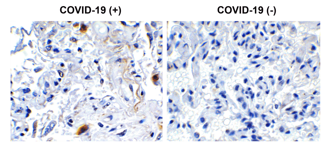 Figure 1 Immunohistochemistry Validation of SARS-CoV-2 (COVID-19) NSP2 in COVID-19 Patient Lung 
Immunohistochemical analysis of paraffin-embedded COVID-19 patient lung tissue using anti- SARS-CoV-2 (COVID-19) NSP2 antibody (9173, 0.5 &#956;g/mL) . Tissue was fixed with formaldehyde and blocked with 10% serum for 1 h at RT; antigen retrieval was by heat mediation with a citrate buffer (pH6) . Samples were incubated with primary antibody overnight at 4&#730;C. A goat anti-rabbit IgG H&L (HRP) at 1/250 was used as secondary. Counter stained with Hematoxylin. Strong signal of SARS-COV-2 NSP2 protein was observed in macrophage of COVID-19 patient lung, but not in non-COVID-19 patient lung.