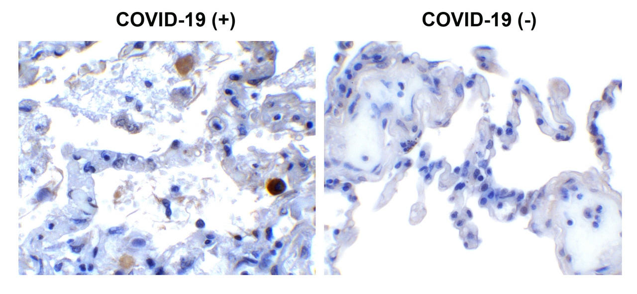 Figure 1 Immunohistochemistry Validation of SARS-CoV-2 (COVID-19) NSP13 in COVID-19 Patient Lung 
Immunohistochemical analysis of paraffin-embedded COVID-19 patient lung tissue using anti- SARS-CoV-2 (COVID-19) NSP13 antibody (9181, 0.5 &#956;g/mL) . Tissue was fixed with formaldehyde and blocked with 10% serum for 1 h at RT; antigen retrieval was by heat mediation with a citrate buffer (pH6) . Samples were incubated with primary antibody overnight at 4&#730;C. A goat anti-rabbit IgG H&L (HRP) at 1/250 was used as secondary. Counter stained with Hematoxylin. Strong signal of SARS-COV-2 NSP13 protein was observed in macrophage of COVID-19 patient lung, but not in non-COVID-19 patient lung.