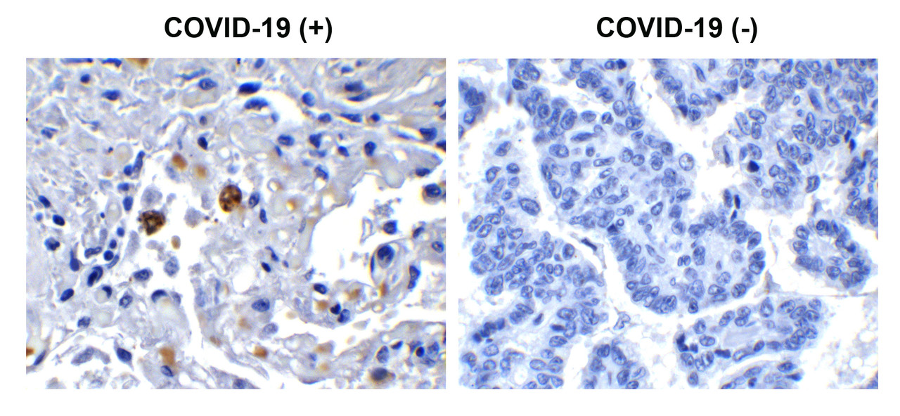 Figure 1 Immunohistochemistry Validation of SARS-CoV-2 (COVID-19) NSP13 in COVID-19 Patient Lung 
Immunohistochemical analysis of paraffin-embedded COVID-19 patient lung tissue using anti- SARS-CoV-2 (COVID-19) NSP13 antibody (9183, 0.5 &#956;g/mL) . Tissue was fixed with formaldehyde and blocked with 10% serum for 1 h at RT; antigen retrieval was by heat mediation with a citrate buffer (pH6) . Samples were incubated with primary antibody overnight at 4&#730;C. A goat anti-rabbit IgG H&L (HRP) at 1/250 was used as secondary. Counter stained with Hematoxylin. Strong signal of SARS-COV-2 NSP13 protein was observed in macrophage of COVID-19 patient lung, but not in non-COVID-19 patient lung.