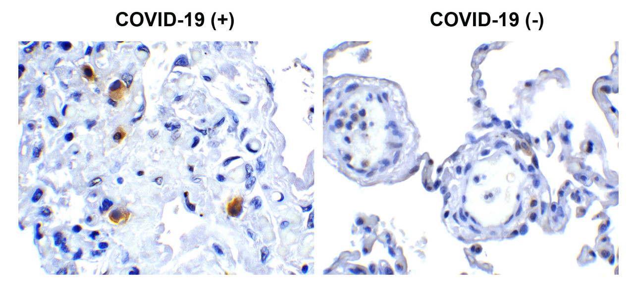 Figure 1 Immunohistochemistry Validation of SARS-CoV-2 (COVID-19) NSP14 in COVID-19 Patient Lung 
Immunohistochemical analysis of paraffin-embedded COVID-19 patient lung tissue using anti- SARS-CoV-2 (COVID-19) NSP14 antibody (9185, 0.5 &#956;g/mL) . Tissue was fixed with formaldehyde and blocked with 10% serum for 1 h at RT; antigen retrieval was by heat mediation with a citrate buffer (pH6) . Samples were incubated with primary antibody overnight at 4&#730;C. A goat anti-rabbit IgG H&L (HRP) at 1/250 was used as secondary. Counter stained with Hematoxylin. Strong signal of SARS-COV-2 NSP14 protein was observed in macrophage of COVID-19 patient lung, but not in non-COVID-19 patient lung.