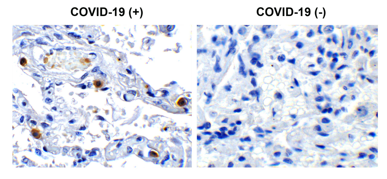 Figure 1 Immunohistochemistry Validation of SARS-CoV-2 (COVID-19) NSP16 in COVID-19 Patient Lung 
Immunohistochemical analysis of paraffin-embedded COVID-19 patient lung tissue using anti- SARS-CoV-2 (COVID-19) NSP16 antibody (9271, 0.5 &#956;g/mL) . Tissue was fixed with formaldehyde and blocked with 10% serum for 1 h at RT; antigen retrieval was by heat mediation with a citrate buffer (pH6) . Samples were incubated with primary antibody overnight at 4&#730;C. A goat anti-rabbit IgG H&L (HRP) at 1/250 was used as secondary. Counter stained with Hematoxylin. Strong signal of SARS-COV-2 NSP16 protein was observed in macrophage of COVID-19 patient lung, but not in non-COVID-19 patient lung.