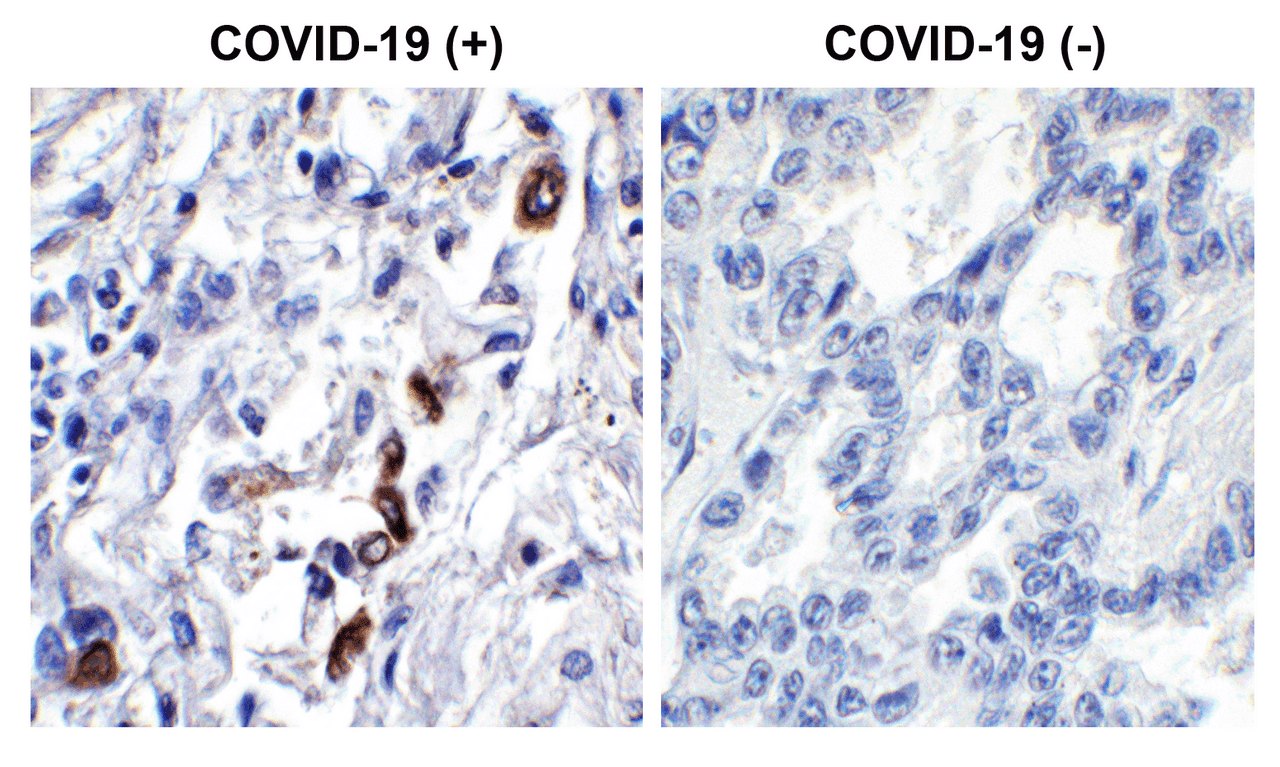 Figure 1 Immunohistochemistry Validation of SARS-CoV-2 (COVID-19) ORF3a in COVID-19 Patient Lung 
Immunohistochemical analysis of paraffin-embedded COVID-19 patient lung tissue using anti- SARS-CoV-2 (COVID-19) ORF3a antibody (9275, 0.2 &#956;g/mL) . Tissue was fixed with formaldehyde and blocked with 10% serum for 1 h at RT; antigen retrieval was by heat mediation with a citrate buffer (pH6) . Samples were incubated with primary antibody overnight at 4&#730;C. A goat anti-rabbit IgG H&L (HRP) at 1/250 was used as secondary. Counter stained with Hematoxylin. Strong signal of SARS-COV-2 ORF3a protein was observed in macrophages of COVID-19 patient lung, but not in non-COVID-19 patient lung.