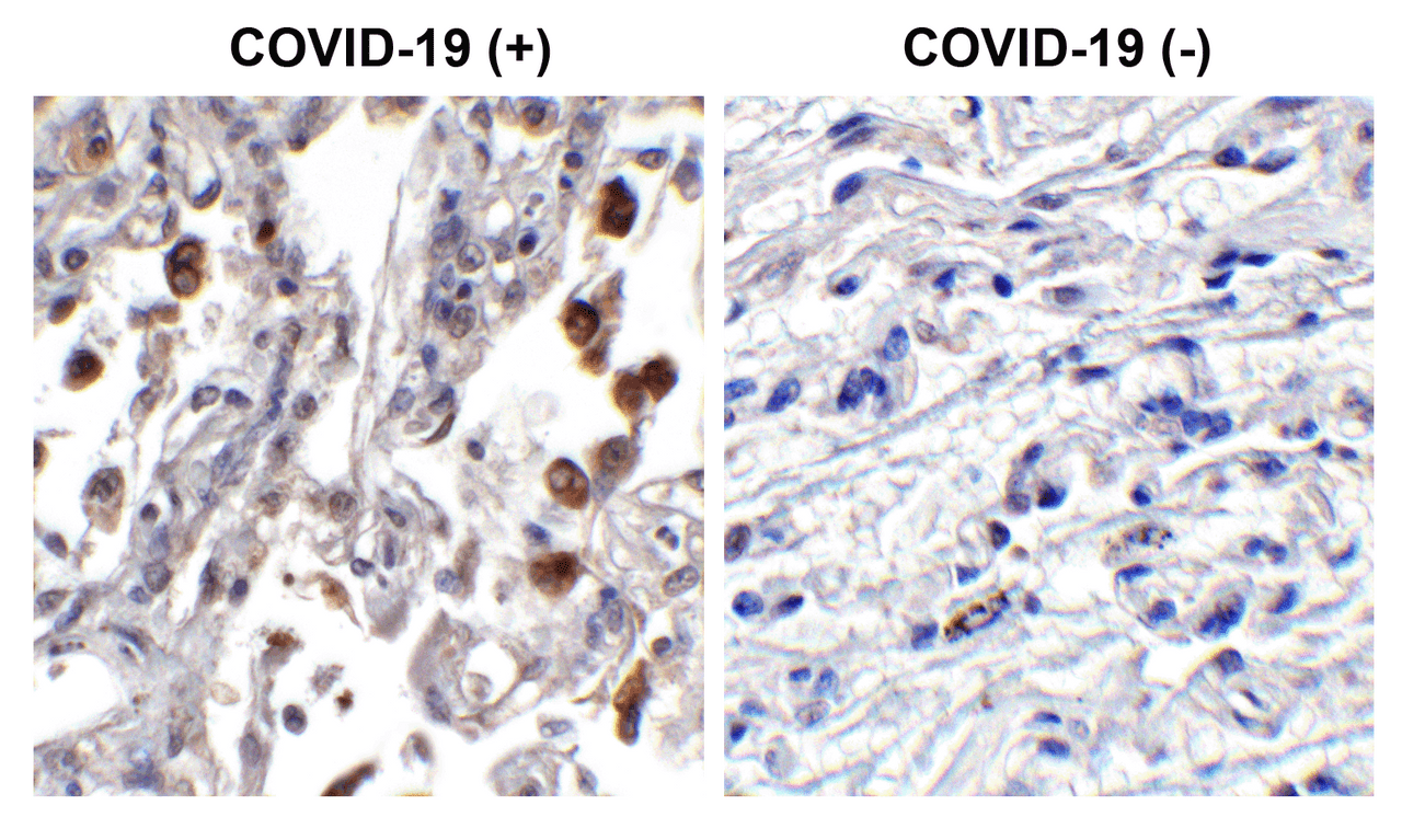 Figure 1 Immunohistochemistry Validation of SARS-CoV-2 (COVID-19) ORF3b in COVID-19 Patient Lung 
Immunohistochemical analysis of paraffin-embedded COVID-19 patient lung tissue using anti- SARS-CoV-2 (COVID-19) ORF3b antibody (9279, 0.5 &#956;g/mL) . Tissue was fixed with formaldehyde and blocked with 10% serum for 1 h at RT; antigen retrieval was by heat mediation with a citrate buffer (pH6) . Samples were incubated with primary antibody overnight at 4&#730;C. A goat anti-rabbit IgG H&L (HRP) at 1/250 was used as secondary. Counter stained with Hematoxylin. Strong signal of SARS-COV-2 ORF3b protein was observed in macrophages of COVID-19 patient lung, but not in non-COVID-19 patient lung.