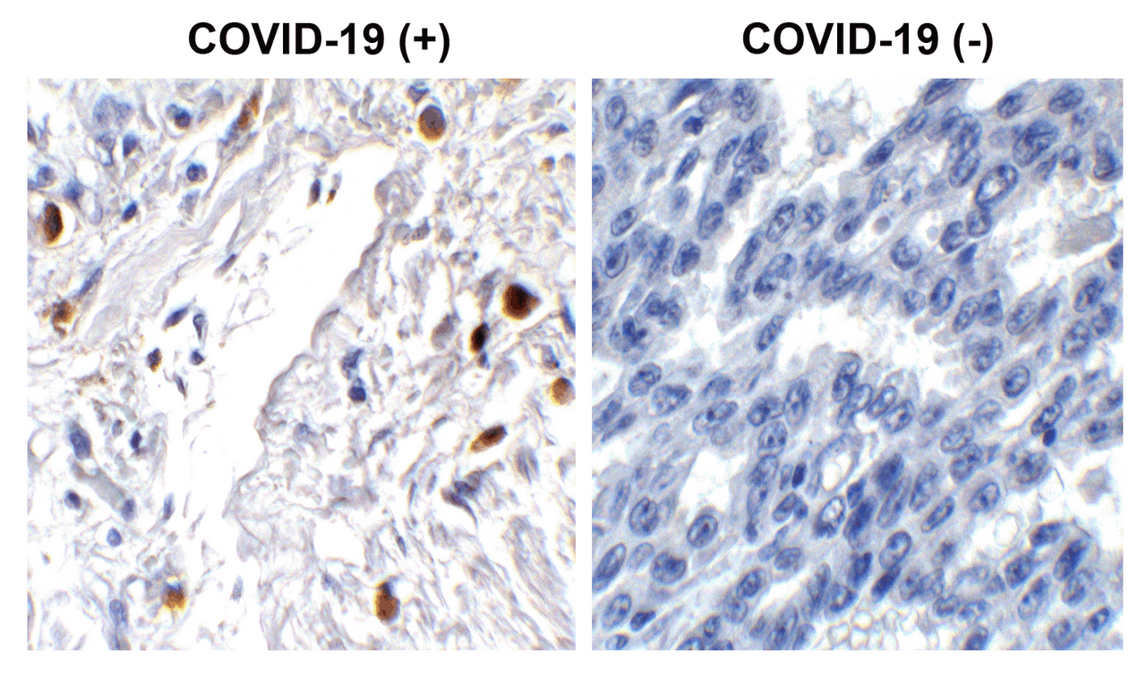 Figure 1 Immunohistochemistry Validation of SARS-CoV-2 (COVID-19) ORF7a in COVID-19 Patient Lung 
Immunohistochemical analysis of paraffin-embedded COVID-19 patient lung tissue using anti- SARS-CoV-2 (COVID-19) ORF7a antibody (9285, 1 &#956;g/mL) . Tissue was fixed with formaldehyde and blocked with 10% serum for 1 h at RT; antigen retrieval was by heat mediation with a citrate buffer (pH6) . Samples were incubated with primary antibody overnight at 4&#730;C. A goat anti-rabbit IgG H&L (HRP) at 1/250 was used as secondary. Counter stained with Hematoxylin. Strong signal of SARS-COV-2 ORF7a protein was observed in macrophages of COVID-19 patient lung, but not in non-COVID-19 patient lung.