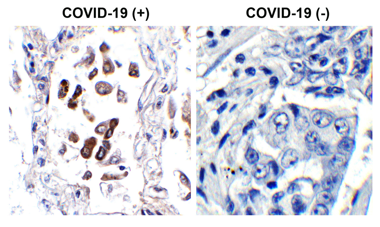 Figure 1 Immunohistochemistry Validation of SARS-CoV-2 (COVID-19) ORF8 in COVID-19 Patient Lung 
Immunohistochemical analysis of paraffin-embedded COVID-19 patient lung tissue using anti- SARS-CoV-2 (COVID-19) ORF8 antibody (9287, 0.1 &#956;g/mL) . Tissue was fixed with formaldehyde and blocked with 10% serum for 1 h at RT; antigen retrieval was by heat mediation with a citrate buffer (pH6) . Samples were incubated with primary antibody overnight at 4&#730;C. A goat anti-rabbit IgG H&L (HRP) at 1/250 was used as secondary. Counter stained with Hematoxylin. Strong signal of SARS-COV-2 ORF8 protein was observed in macrophages of COVID-19 patient lung, but not in non-COVID-19 patient lung.
