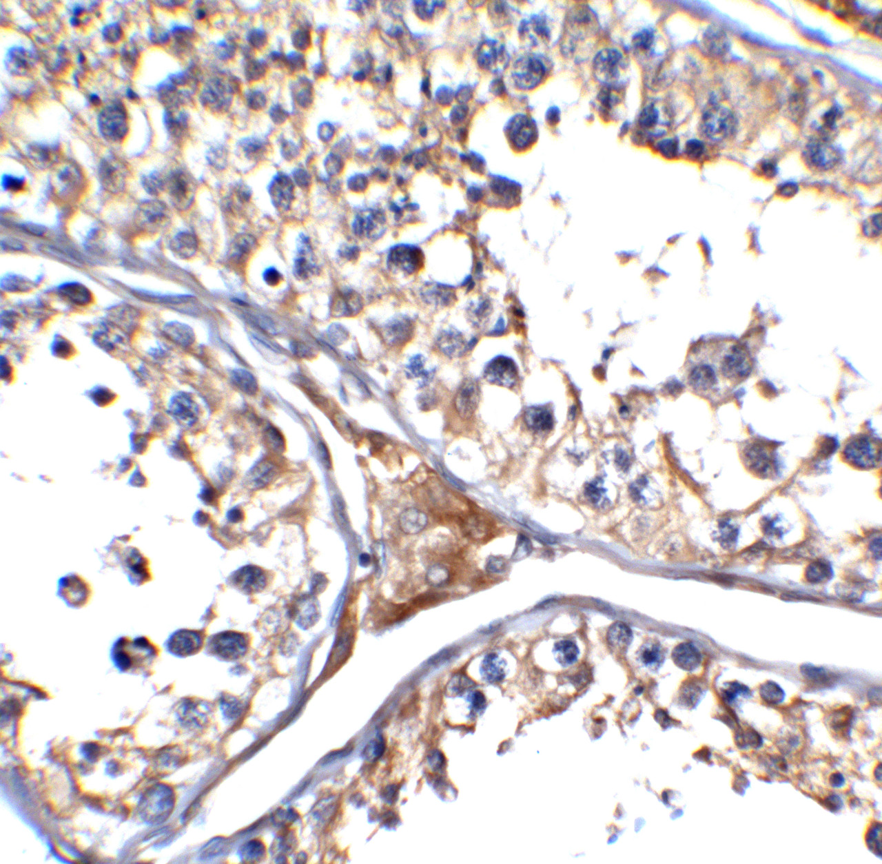 Figure 2 Immunohistochemistry Validation of ACE-2 in COVID-19 Patient Lung 
Immunohistochemical analysis of paraffin-embedded human testis tissue using anti- ACE2 antibody (3217-HRP, 5 ug/mL) . Tissue was fixed with formaldehyde and blocked with 10% serum for 1 h at RT; antigen retrieval was by heat mediation with a citrate buffer (pH6) . Samples were incubated with primary antibody overnight at 4&#730;C.Counter stained with Hematoxylin.