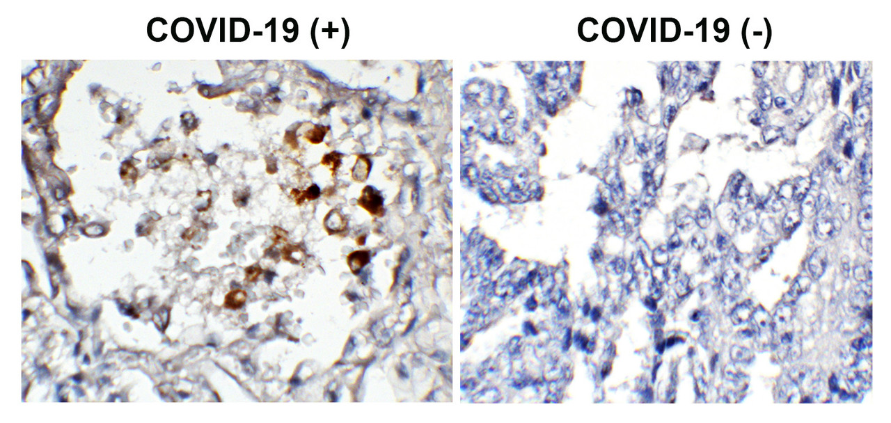 Figure 1 Immunohistochemistry Validation of SARS-CoV-2 (COVID-19) Spike in COVID-19 Patient Lung 
Immunohistochemical analysis of paraffin-embedded COVID-19 patient lung tissue using anti- SARS-CoV-2 (COVID-19) spike antibody (3525-biotin, 2 &#956;g/mL) . Tissue was fixed with formaldehyde and blocked with 10% serum for 1 h at RT; antigen retrieval was by heat mediation with a citrate buffer (pH6) . Samples were incubated with primary antibody overnight at 4&#730;C, following by streptavidin-HRP conjugate at 20 &#956;g/mL. Counter stained with Hematoxylin. Strong signal of SARS-COV-2 spike protein was observed in macrophages of COVID-19 patient lung, but not in non-COVID-19 patient lung.