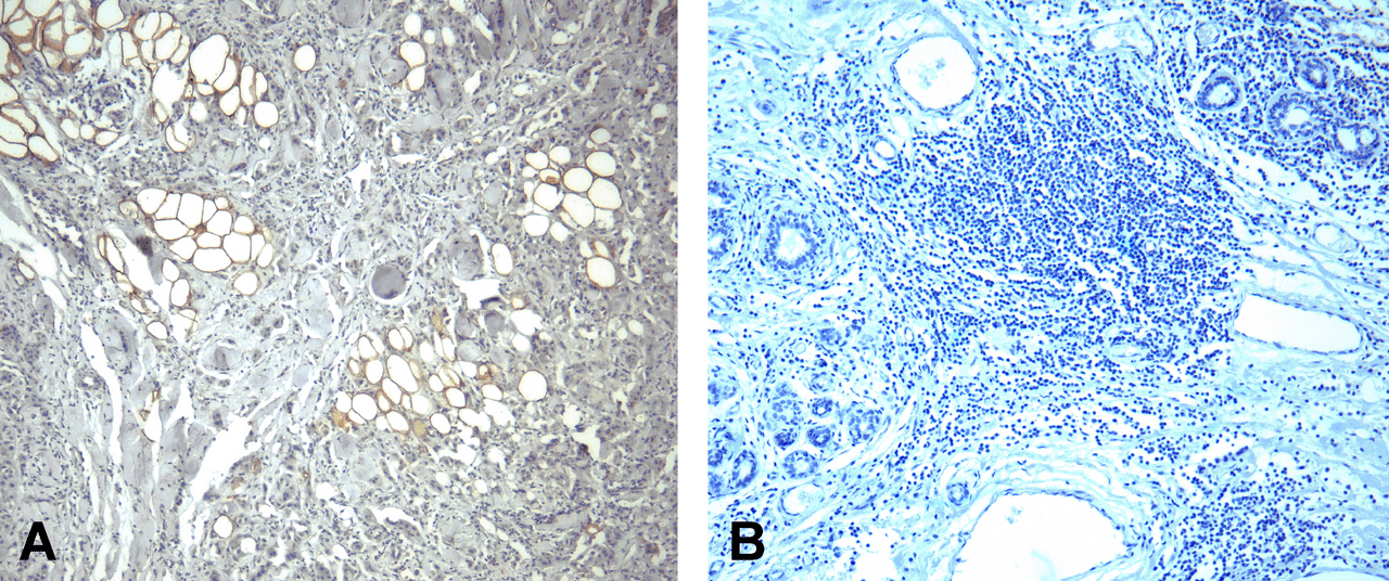 (A) Immunohistochemistry of PD-1 in human breast cancer tissue with PD-1 [4C7] antibody at 10 ug/mL. (B) Immunohistochemistry in human breast cancer tissue with control mouse IgG staining at 10 ug/mL.