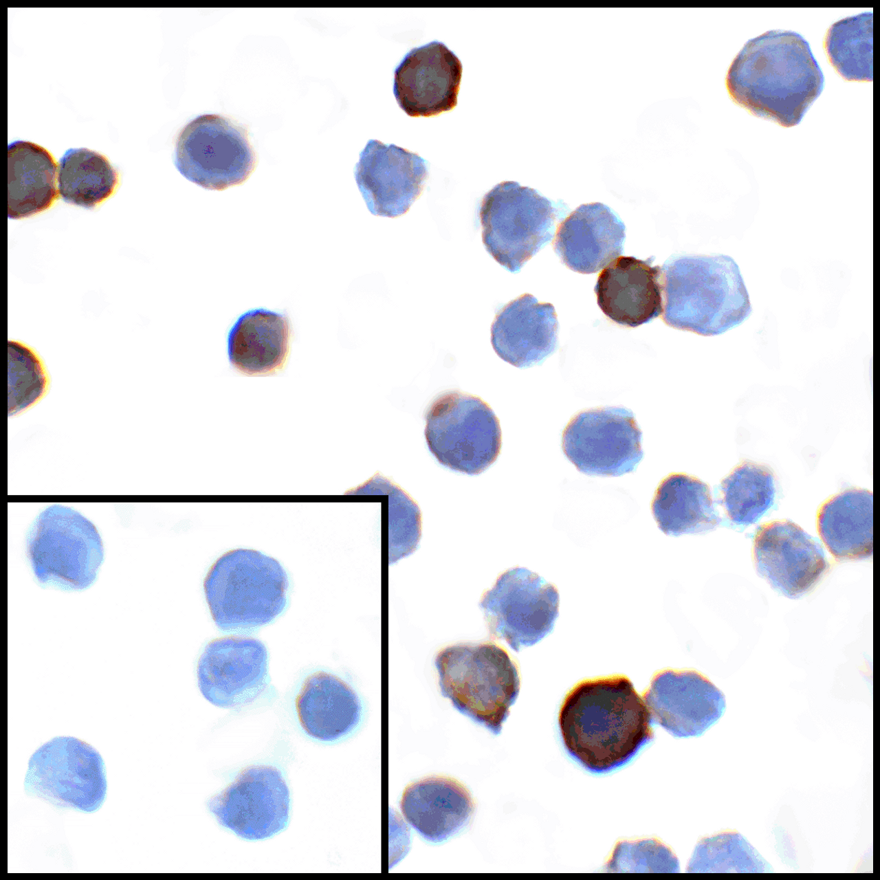Immunocytochemistry of PD-L1 in transfected HEK293 cells with PD-L1 antibody at 1 ug/mL. Lower left: Immunocytochemistry in transfected HEK293 cells with control mouse IgG antibody at 1 ug/mL.