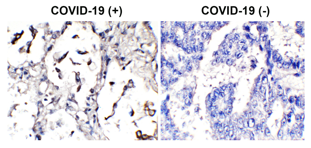 Figure 1 Immunohistochemistry Validation of SARS-CoV-2 (COVID-19) Spike in COVID-19 Patient Lung 
Immunohistochemical analysis of paraffin-embedded COVID-19 patient lung tissue using anti- SARS-CoV-2 (COVID-19) spike antibody (3525-HRP, 2 &#956;g/mL) . Tissue was fixed with formaldehyde and blocked with 10% serum for 1 h at RT; antigen retrieval was by heat mediation with a citrate buffer (pH6) . Samples were incubated with primary antibody overnight at 4&#730;C. Counter stained with Hematoxylin. Strong signal of SARS-COV-2 spike protein was observed in macrophages of COVID-19 patient lung, but not in non-COVID-19 patient lung.