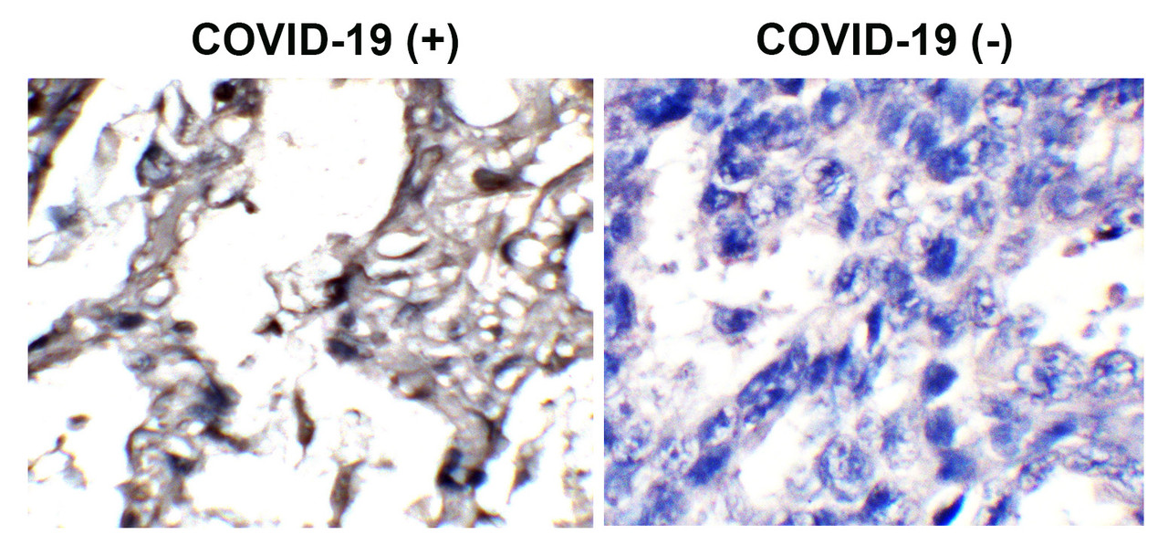 Figure 2 Immunohistochemistry Validation of SARS-CoV-2 (COVID-19) Envelope Protein in COVID-19 Patient Lung 
Immunohistochemical analysis of paraffin-embedded COVID-19 patient lung tissue using anti- SARS-CoV-2 (COVID-19) envelope antibody (3531-HRP, 2 ug/mL) . Tissue was fixed with formaldehyde and blocked with 10% serum for 1 h at RT; antigen retrieval was by heat mediation with a citrate buffer (pH6) . Samples were incubated with primary antibody overnight at 4&#730;C, following by streptavidin-HRP conjugate at 20 ug/mL. Counter stained with Hematoxylin. Strong signal of SARS-COV-2 envelope protein was observed in macrophages of COVID-19 patient lung, but not in non-COVID-19 patient lung.