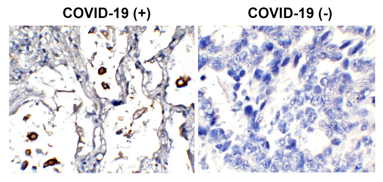 Figure 1 Immunohistochemistry Validation of SARS-CoV-2 (COVID-19) Nucleocapsid Protein in COVID-19 Patient Lung 
Immunohistochemical analysis of paraffin-embedded COVID-19 patient lung tissue using anti- SARS-CoV-2 (COVID-19) nucleocapsid antibody (9099-HRP, 2 &#956;g/mL) . Tissue was fixed with formaldehyde and blocked with 10% serum for 1 h at RT; antigen retrieval was by heat mediation with a citrate buffer (pH6) . Samples were incubated with primary antibody overnight at 4&#730;C. Counter stained with Hematoxylin. Strong signal of SARS-COV-2 nucleocapsid protein was observed in macrophages of COVID-19 patient lung, but not in non-COVID-19 patient lung.