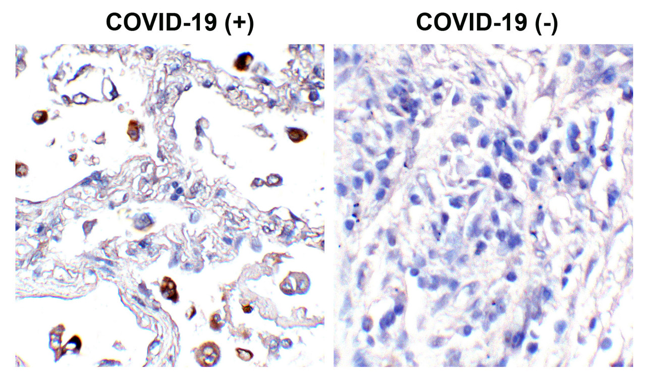 Figure 1 Immunohistochemistry Validation of SARS-CoV-2 (COVID-19) Spike in COVID-19 Patient Lung Immunohistochemical analysis of paraffin-embedded COVID-19 patient lung tissue using anti-SARS-CoV-2 (COVID-19) Spike S2 antibody (PM-9428, 0.5 &#956;g/mL) . Tissue was fixed with formaldehyde and blocked with 10% serum for 1 h at RT; antigen retrieval was by heat mediation with a citrate buffer (pH6) . Samples were incubated with primary antibody overnight at 4&#730;. A goat anti-mouse IgG H&L (HRP) at 1/250 was used as secondary. Counter stained with Hematoxylin. Strong spike protein signal was observed in macrophages of COVID-19 patient lung, but not in non-COVID-19 patient lung.