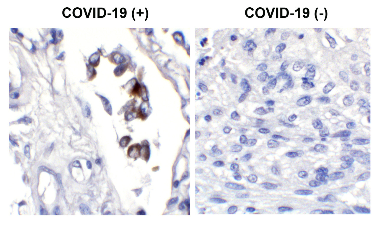 <strong>Figure 2 Immunohistochemistry Validation of SARS-CoV-2 (COVID-19) Spike in COVID-19 Patient Lung</strong><br> 
Immunohistochemical analysis of paraffin-embedded COVID-19 patient lung tissue using anti- SARS-CoV-2 (COVID-19) Spike antibody (10-350, 3 ug/mL) . Tissue was fixed with formaldehyde and blocked with 10% serum for 1 h at RT; antigen retrieval was by heat mediation with a citrate buffer (pH6) . Samples were incubated with primary antibody overnight at 4&#730;C. A goat anti-rabbit IgG H&L (HRP) at 1/250 was used as secondary. Counter stained with Hematoxylin. Strong signal of SARS-COV-2 Spike protein was observed in the macrophages of COVID-19 patient lung, but not in non-COVID-19 patient lung.