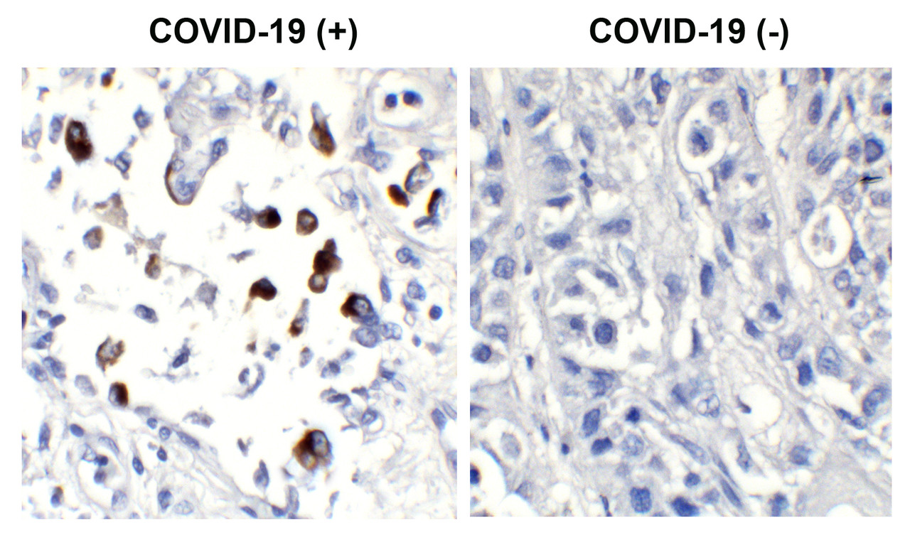 <strong>Figure 2 Immunohistochemistry Validation of SARS-CoV-2 (COVID-19) Spike in COVID-19 Patient Lung</strong><br> 
Immunohistochemical analysis of paraffin-embedded COVID-19 patient lung tissue using anti- SARS-CoV-2 (COVID-19) Spike antibody (10-351, 3 ug/mL) . Tissue was fixed with formaldehyde and blocked with 10% serum for 1 h at RT; antigen retrieval was by heat mediation with a citrate buffer (pH6) . Samples were incubated with primary antibody overnight at 4&#730;C. A goat anti-rabbit IgG H&L (HRP) at 1/250 was used as secondary. Counter stained with Hematoxylin. Strong signal of SARS-COV-2 Spike protein was observed in the macrophages of COVID-19 patient lung, but not in non-COVID-19 patient lung.