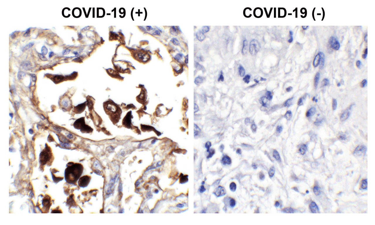 <strong>Figure 1 Immunohistochemistry Validation of SARS-CoV-2 (COVID-19) Nucleocapsid in COVID-19 Patient Lung</strong><br> 
Immunohistochemical analysis of paraffin-embedded COVID-19 patient lung tissue using anti- SARS-CoV-2 (COVID-19) Nucleocapsid antibody (10-352, 1 ug/mL) . Tissue was fixed with formaldehyde and blocked with 10% serum for 1 h at RT; antigen retrieval was by heat mediation with a citrate buffer (pH6) . Samples were incubated with primary antibody overnight at 4&#730;C. A goat anti-rabbit IgG H&L (HRP) at 1/250 was used as secondary. Counter stained with Hematoxylin. Strong signal of SARS-COV-2 Nucleocapsid protein was observed in the macrophages of COVID-19 patient lung, but not in non-COVID-19 patient lung.