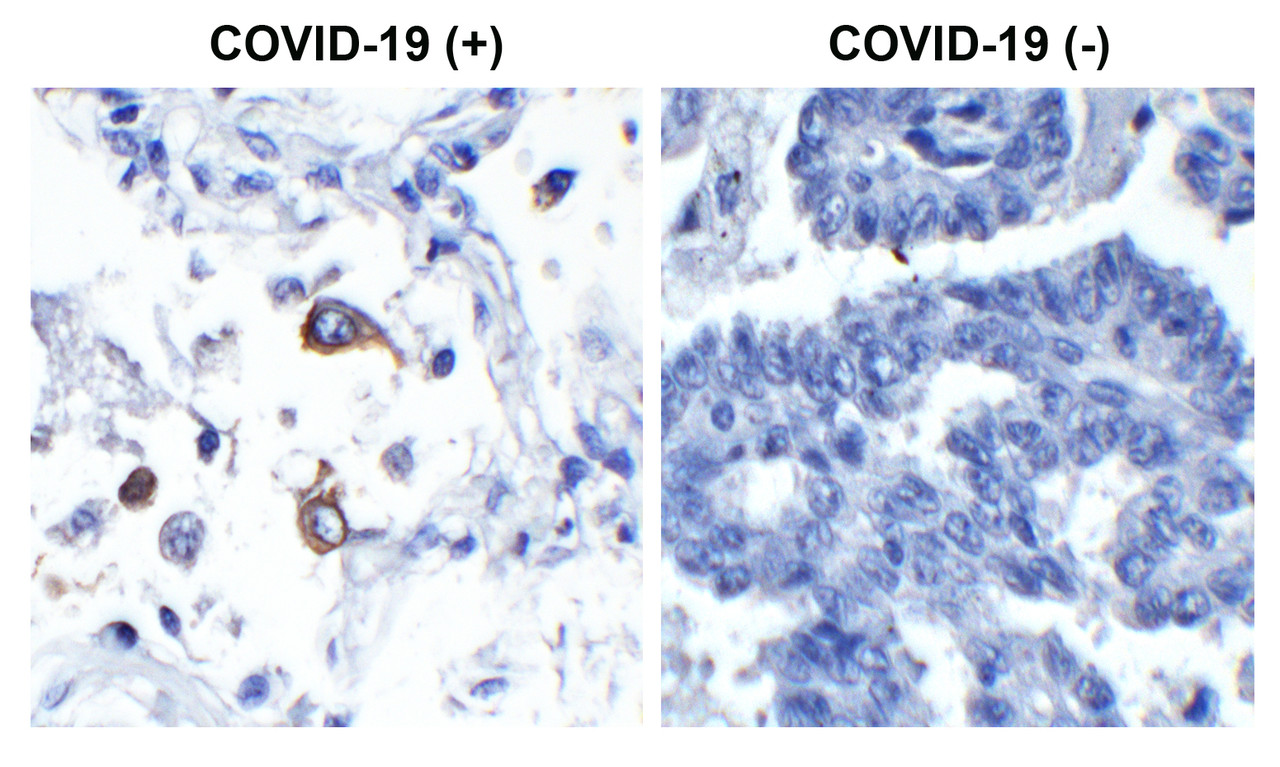 <strong>Figure 1 Immunohistochemistry Validation of SARS-CoV-2 (COVID-19) Nucleocapsid in COVID-19 Patient Lung</strong><br> 
Immunohistochemical analysis of paraffin-embedded COVID-19 patient lung tissue using anti- SARS-CoV-2 (COVID-19) Nucleocapsid antibody (10-750, 1 ng/mL) . Tissue was fixed with formaldehyde and blocked with 10% serum for 1 h at RT; antigen retrieval was by heat mediation with a citrate buffer (pH6) . Samples were incubated with primary antibody overnight at 4&#730;C. A goat anti-rabbit IgG H&L (HRP) at 1/250 was used as secondary. Counter stained with Hematoxylin. Strong signal of SARS-COV-2 Nucleocapsid protein was observed in the macrophages of COVID-19 patient lung, but not in non-COVID-19 patient lung.
