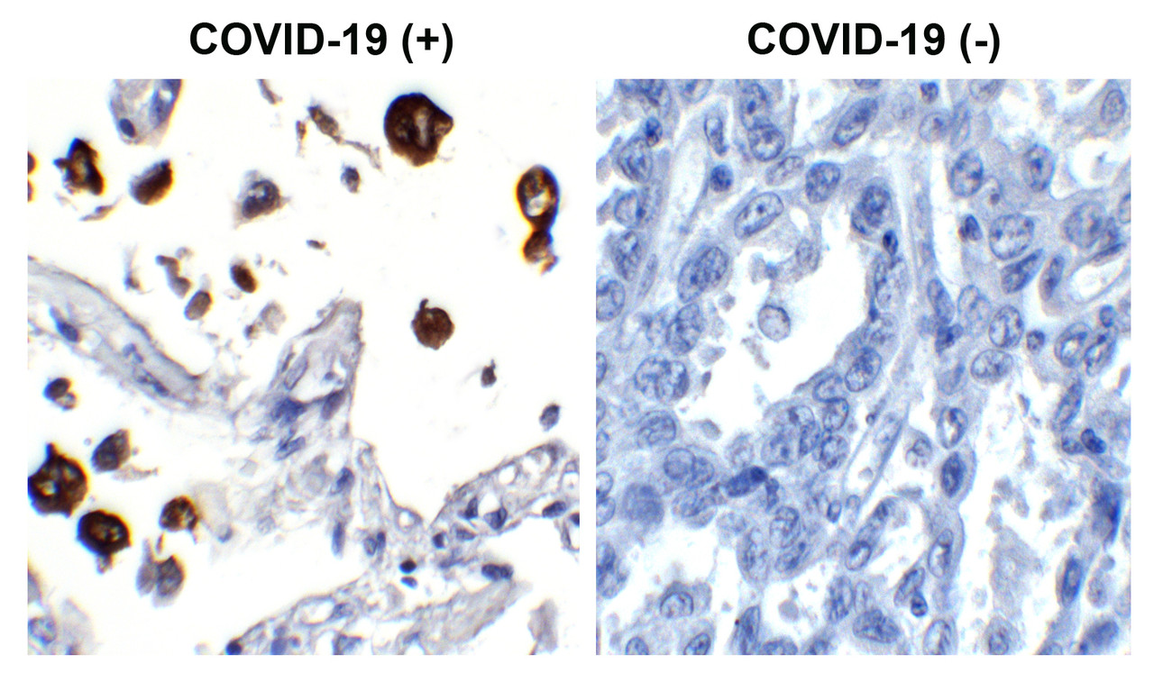 <strong>Figure 1 Immunohistochemistry Validation of SARS-CoV-2 (COVID-19) Nucleocapsid in COVID-19 Patient Lung</strong><br> 
Immunohistochemical analysis of paraffin-embedded COVID-19 patient lung tissue using anti- SARS-CoV-2 (COVID-19) Nucleocapsid antibody (10-751, 5 ng/mL) . Tissue was fixed with formaldehyde and blocked with 10% serum for 1 h at RT; antigen retrieval was by heat mediation with a citrate buffer (pH6) . Samples were incubated with primary antibody overnight at 4&#730;C. A goat anti-rabbit IgG H&L (HRP) at 1/250 was used as secondary. Counter stained with Hematoxylin. Strong signal of SARS-COV-2 Nucleocapsid protein was observed in the macrophages of COVID-19 patient lung, but not in non-COVID-19 patient lung.