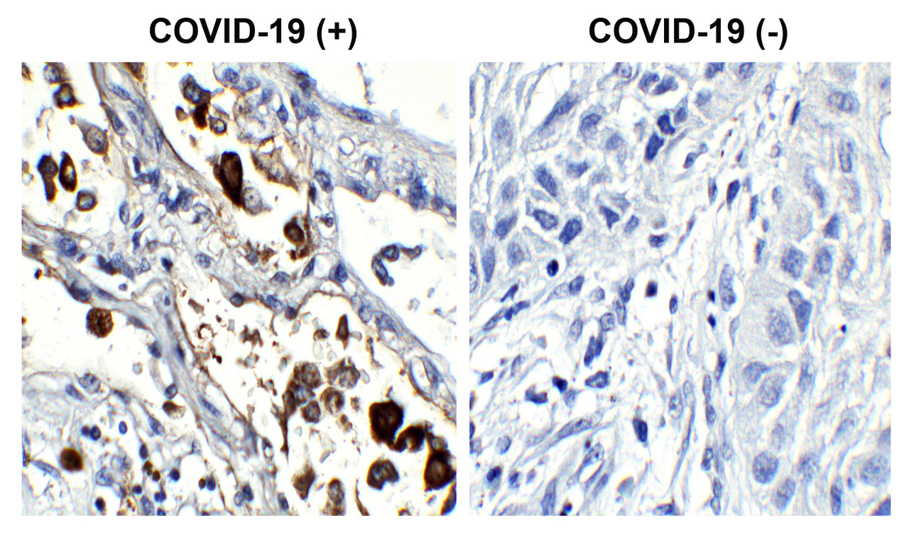 <strong>Figure 1 Immunohistochemistry Validation of SARS-CoV-2 (COVID-19) Nucleocapsid in COVID-19 Patient Lung</strong><br> 
Immunohistochemical analysis of paraffin-embedded COVID-19 patient lung tissue using anti- SARS-CoV-2 (COVID-19) Nucleocapsid antibody (10-752, 1 ug/mL) . Tissue was fixed with formaldehyde and blocked with 10% serum for 1 h at RT; antigen retrieval was by heat mediation with a citrate buffer (pH6) . Samples were incubated with primary antibody overnight at 4&#730;C. A goat anti-rabbit IgG H&L (HRP) at 1/250 was used as secondary. Counter stained with Hematoxylin. Strong signal of SARS-COV-2 Nucleocapsid protein was observed in the macrophages of COVID-19 patient lung, but not in non-COVID-19 patient lung.
