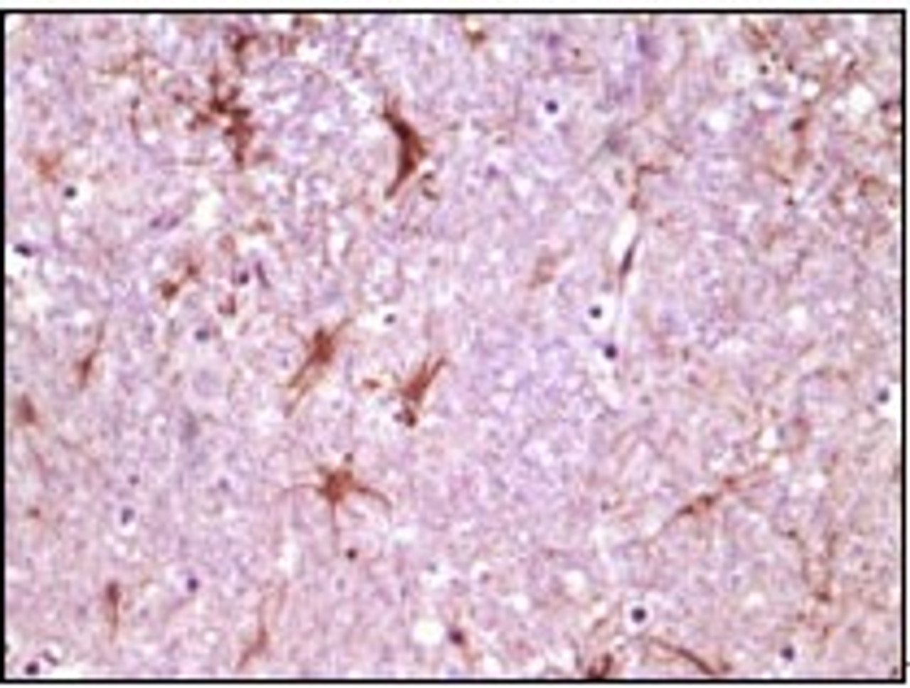 Immunohistochemical analysis of paraffin - embedded human glioma tissue showing membrane location using CIB1 antibody with DAB staining.