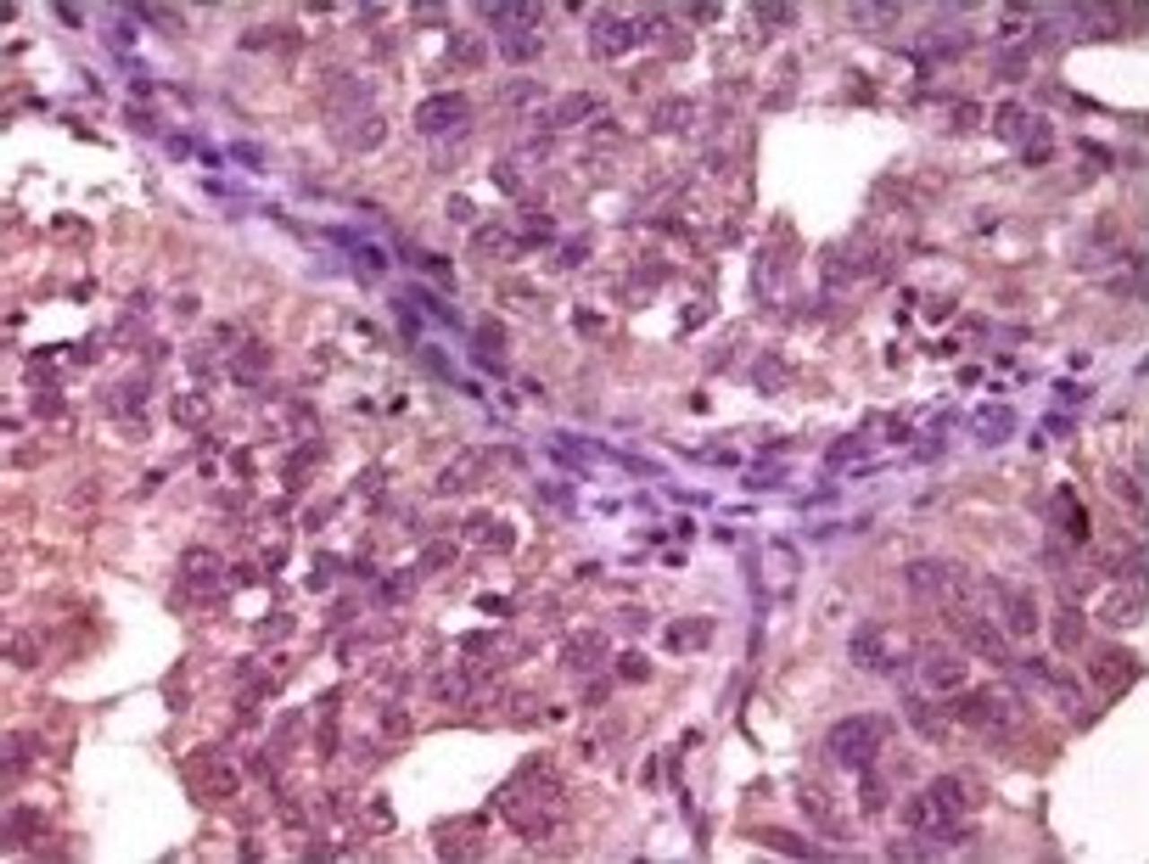 Immunohistochemical analysis of paraffin - embedded human ovary carcinoma showing cytoplasmic location using EphA1 antibody with DAB.