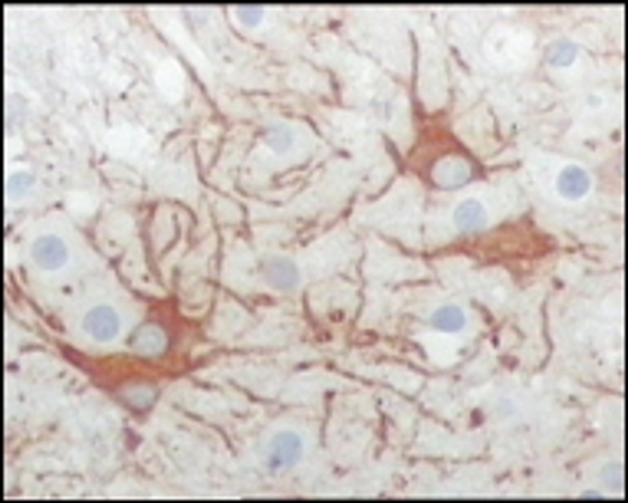 Immunohistochemical analysis of paraffin - embedded human cerebrum tumor tissue (top) and human lymphocyte of thymus (bottom) showing cytoplasma location using FES antibody with DAB staining.