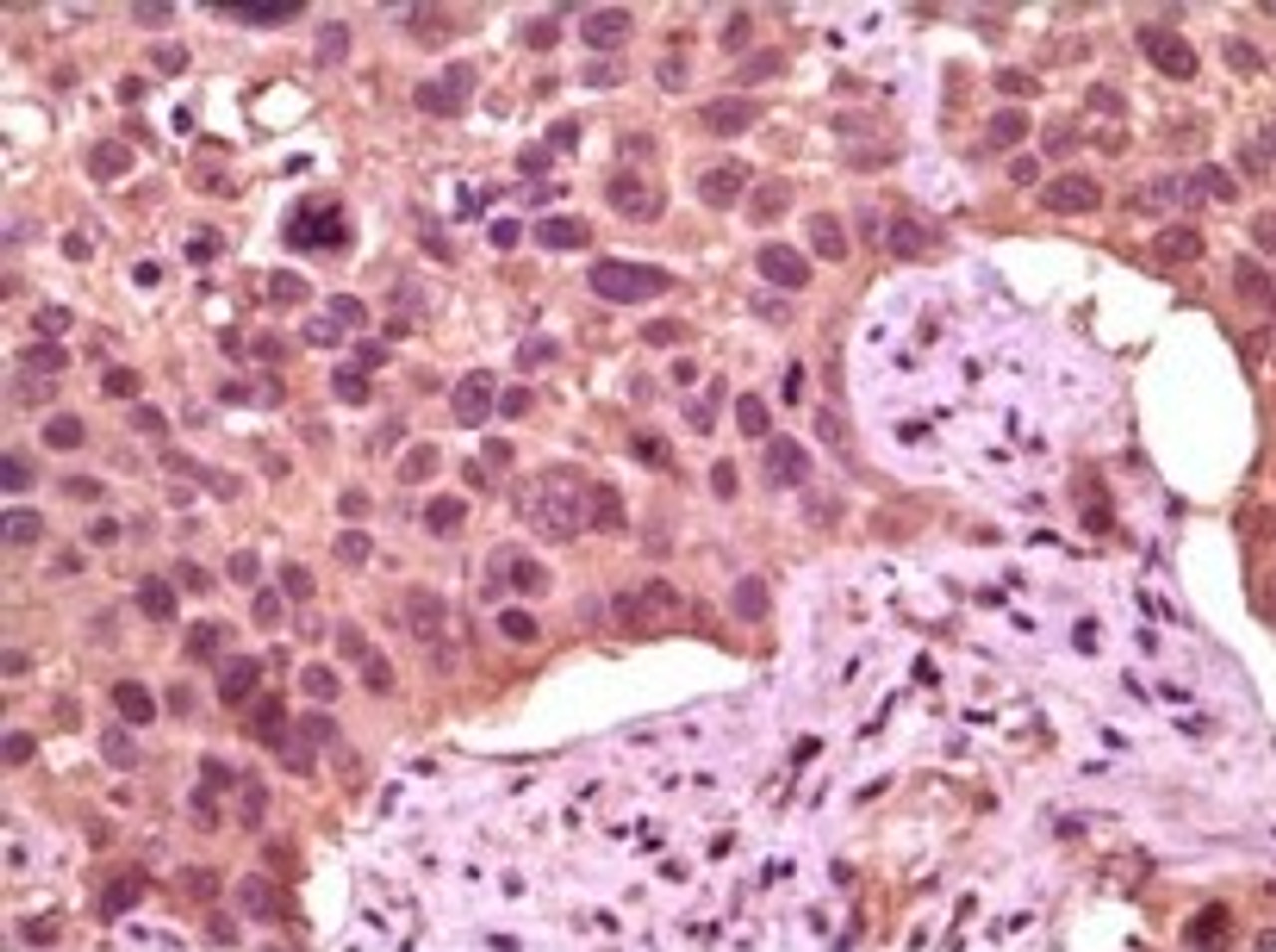 Immunohistochemical analysis of paraffin - embedded human lung carcinoma showing cytoplasmic localization using GSK3 alpha antibody with DAB staining.