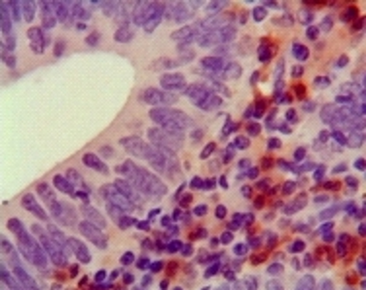 Immunohistochemical analysis of paraffin - embedded human colon cancer (top) and pancreas cancer (bottom) showing cytoplasma localization using HCK antibody with DAB staining.