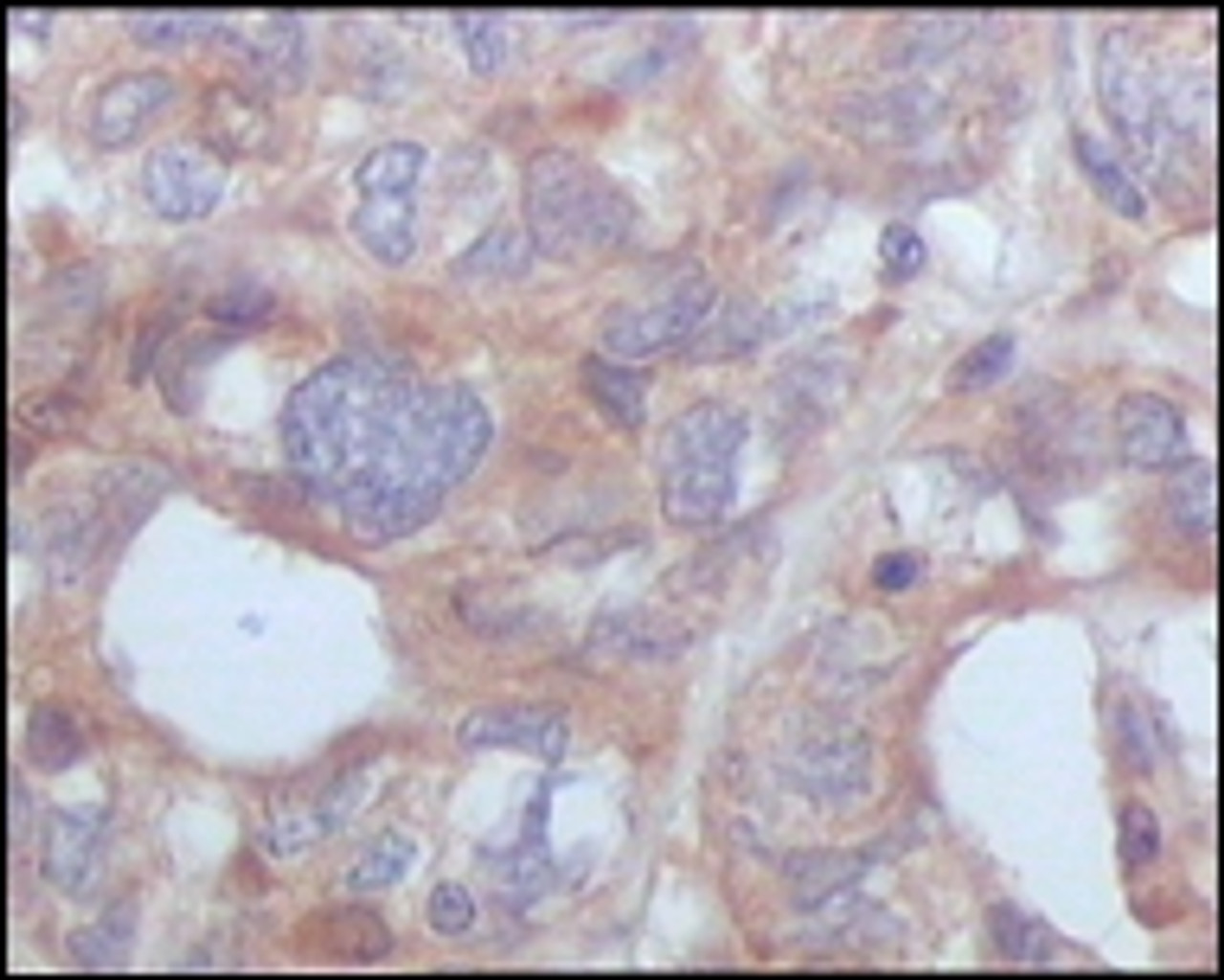 Immunohistochemical analysis of paraffin - embedded human ovary carcinoma (top) and human normal cerebrum (bottom) showing cytoplasmic location using STYK1 / NOK antibody with DAB staining.