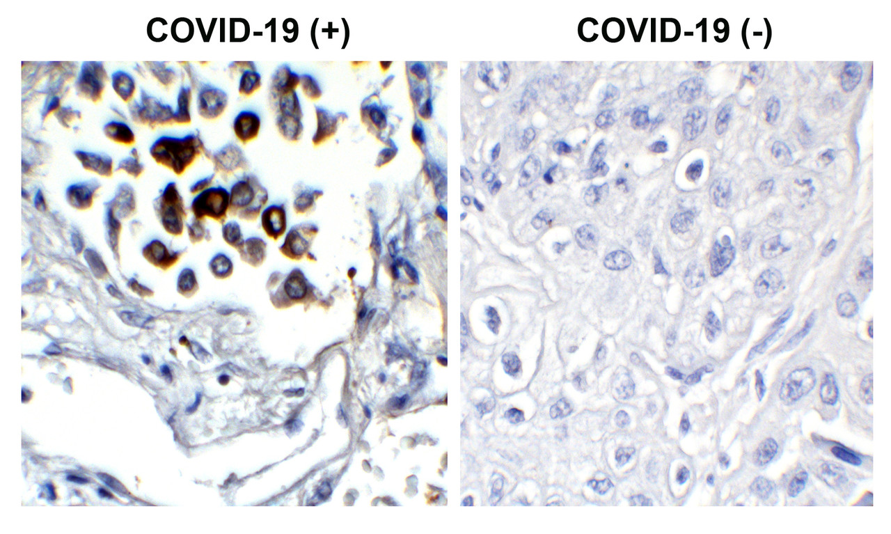 <strong>Figure 1 Immunohistochemistry Validation of SARS-CoV-2 (COVID-19) Nucleocapsid in COVID-19 Patient Lung</strong><br> 
Immunohistochemical analysis of paraffin-embedded COVID-19 patient lung tissue using anti- SARS-CoV-2 (COVID-19) Nucleocapsid antibody (35-719, 1 ug/mL) . Tissue was fixed with formaldehyde and blocked with 10% serum for 1 h at RT; antigen retrieval was by heat mediation with a citrate buffer (pH6) . Samples were incubated with primary antibody overnight at 4&#730;C. A goat anti-rabbit IgG H&L (HRP) at 1/250 was used as secondary. Counter stained with Hematoxylin. Strong signal of SARS-COV-2 Nucleocapsid protein was observed in the macrophages of COVID-19 patient lung, but not in non-COVID-19 patient lung